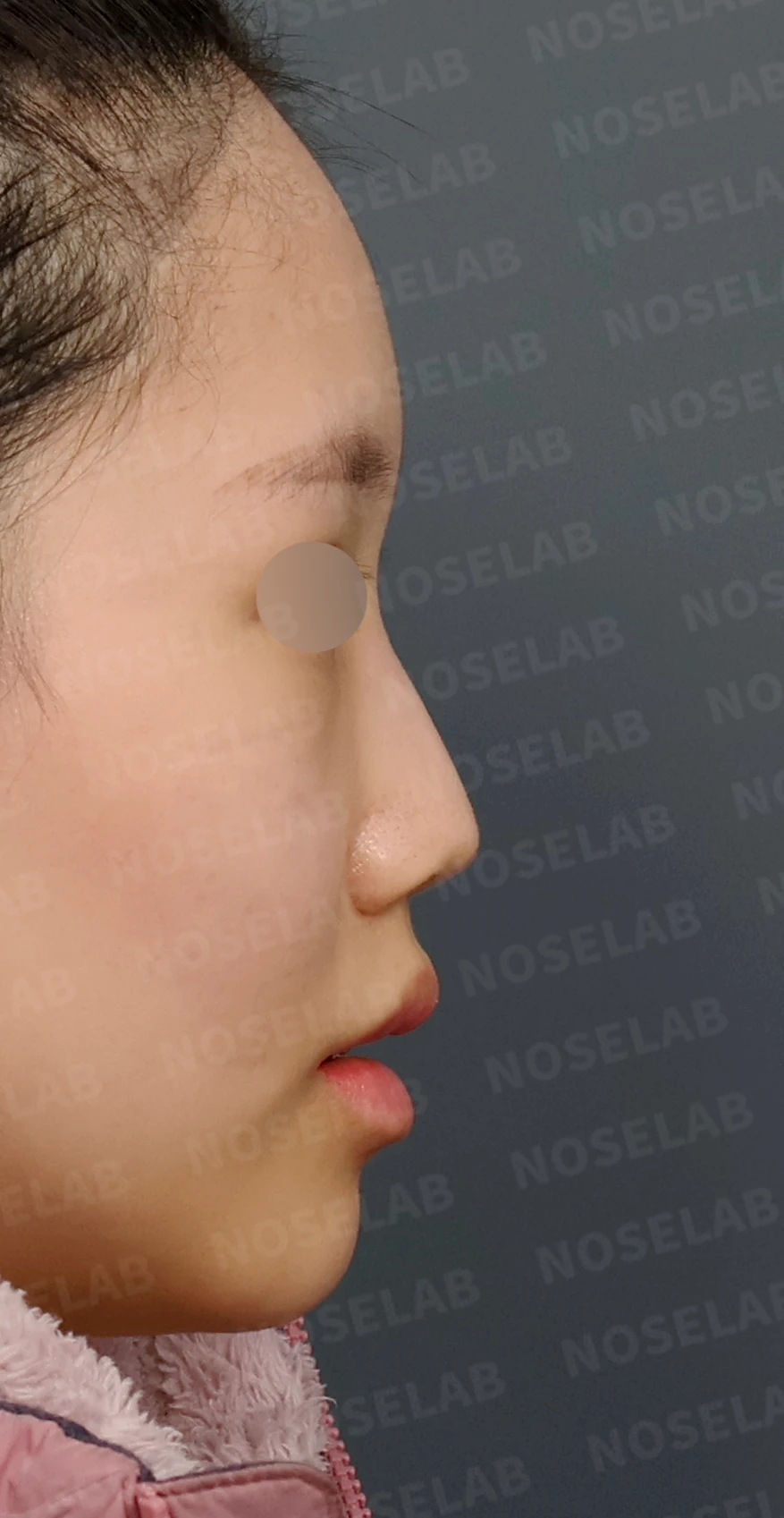 무보형물 코성형, 휘어진 콧대와 처진 코끝을 자연스럽게 교정 — 디자인 상담 우측 측면, 비스듬한 측면, 비공 사진입니다.