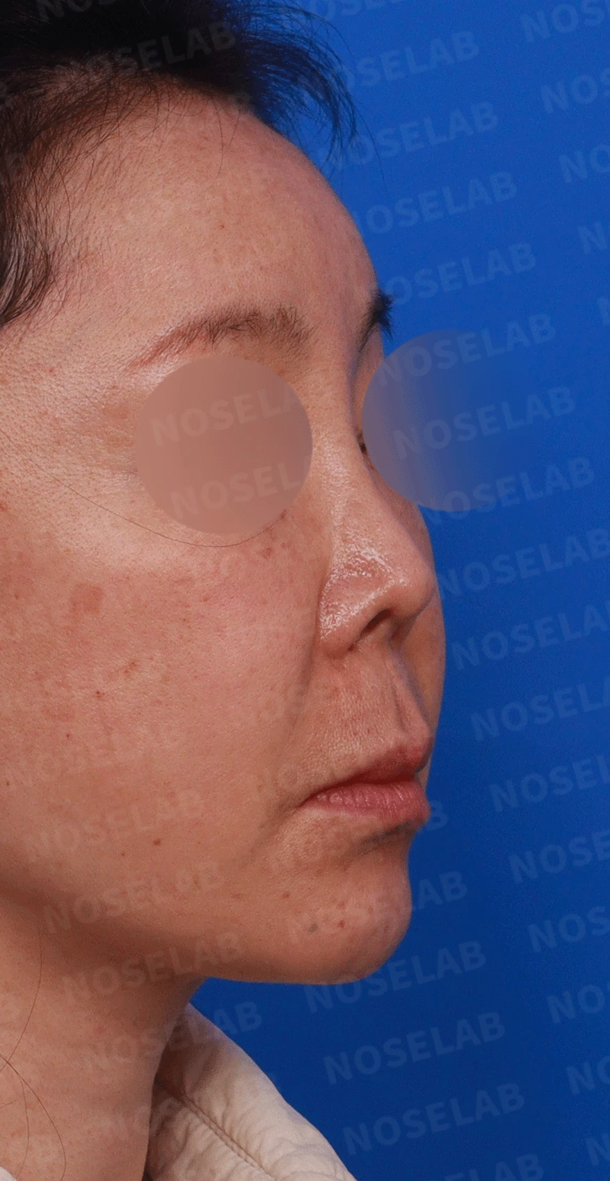 코가 짧고 들리며 비주가 함몰되는 이유, 자가 늑연골 재건은 어떻게 하나 — 본문 사진 6