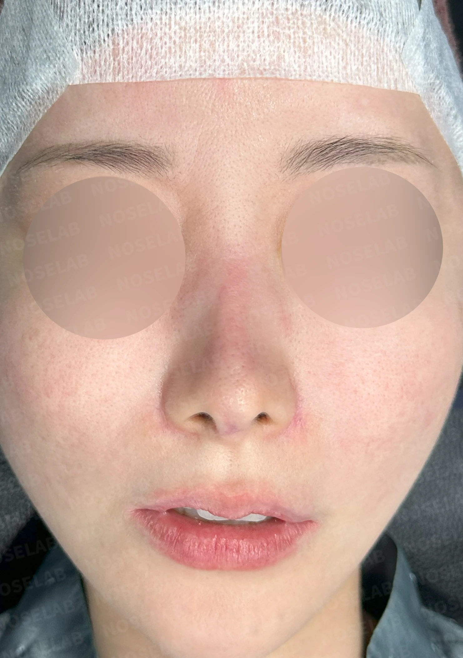 코성형 후 남는 미세한 높이 부족과 좌우 비대칭, 왜 생기고 어떻게 보강하나 — 수술 전 / 수술 직후 0일 직후 사진은 부기가 있는 상태로 최종 결과와 다를 수 있습니다.