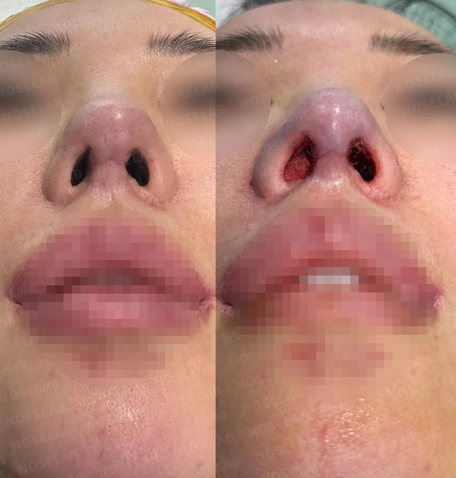 복코와 휜코, 콧구멍 비대칭의 자가늑연골 재수술 방법 — 수술 전 / 수술 직후 0일 직후 사진은 부기가 있는 상태로 최종 결과와 다를 수 있습니다.