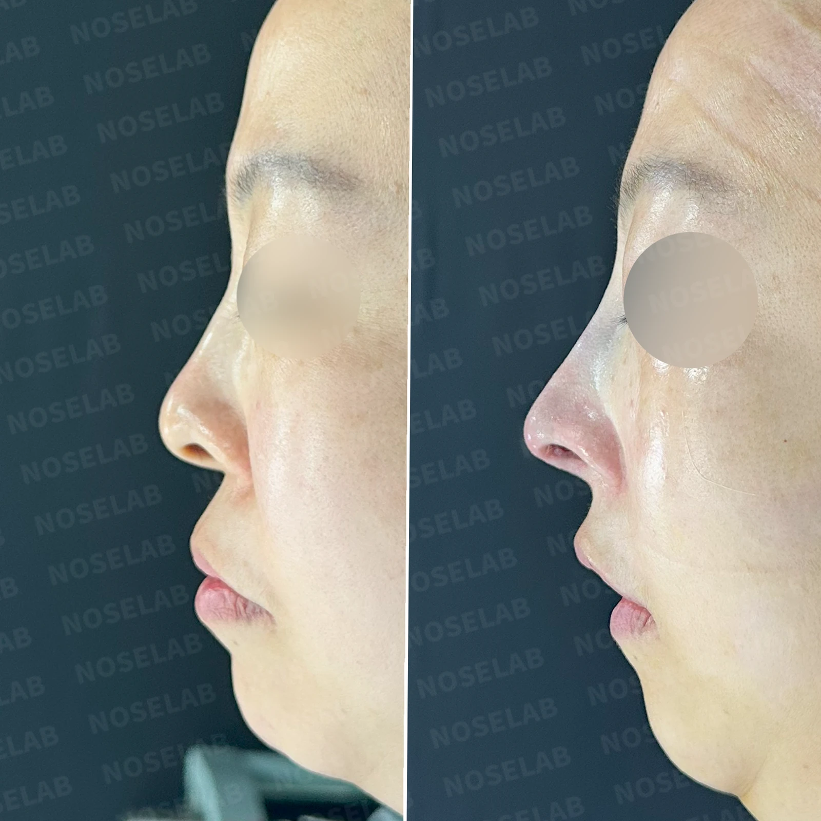 들창코에서 콧구멍이 많이 보이는 이유, 코끝 위치 교정은 어떻게 하나 — 본문 사진 20