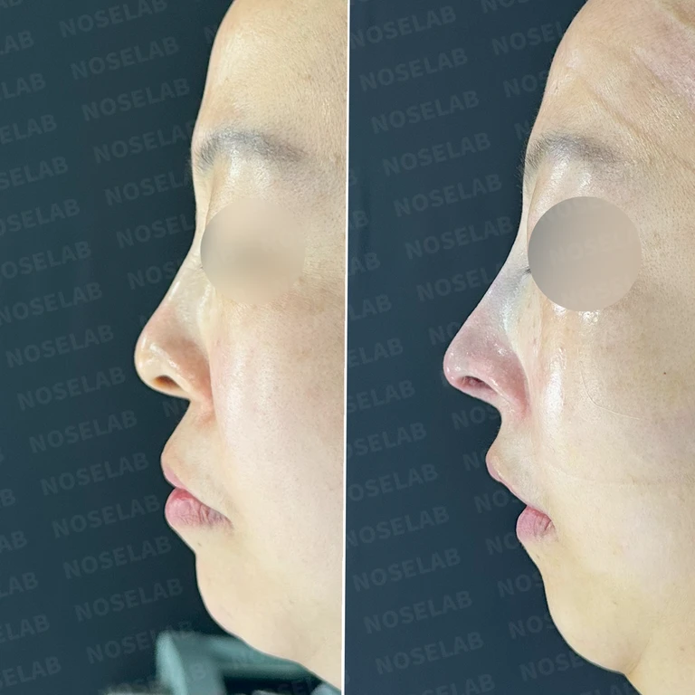 들창코 교정과 콧구멍 노출 개선 - 자연스러운 코 후기 — 전후 비교