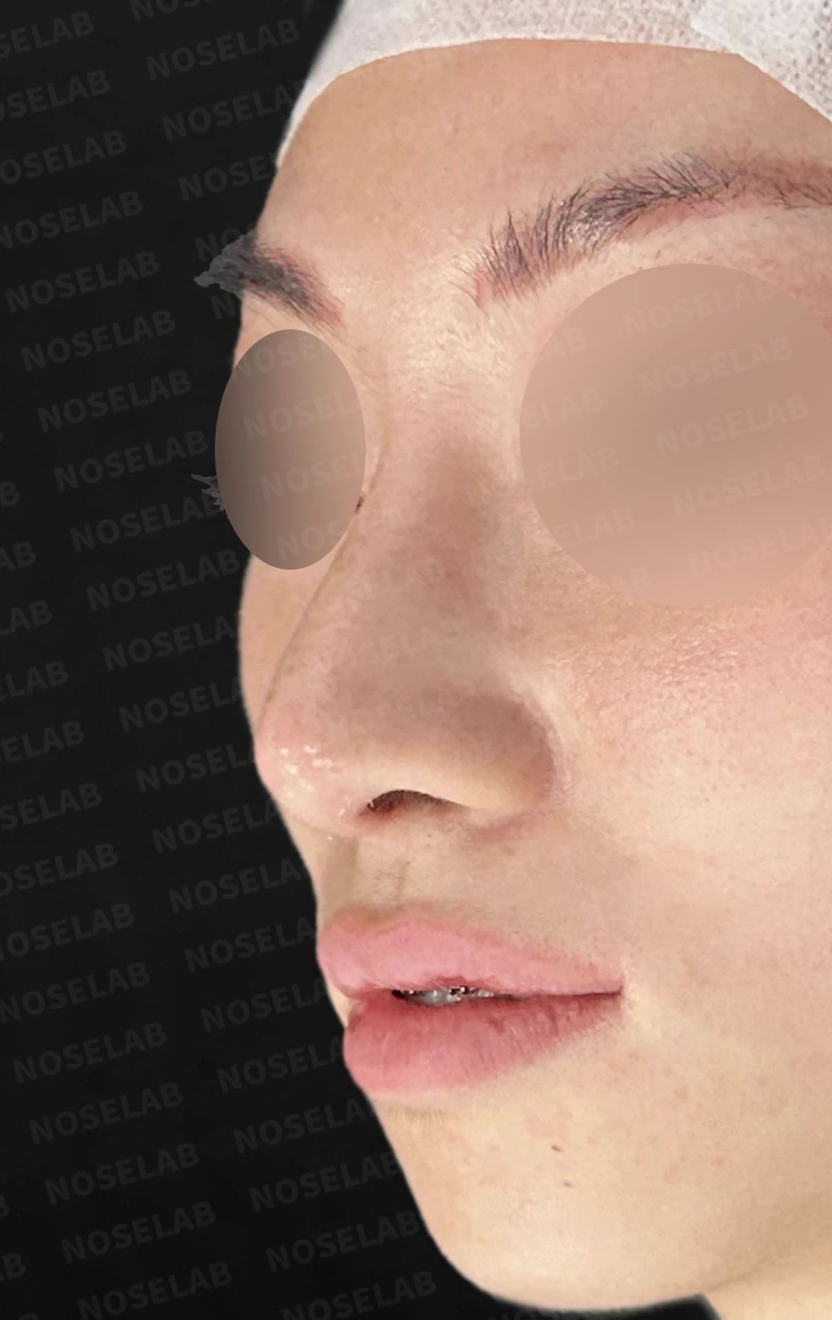 자가 늑연골 코재수술, 콧대부터 코끝까지 슬림하고 여성스럽게 — 전(좌) 직후(후)