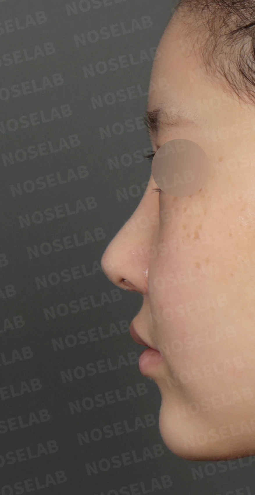 휘어진 코와 복코, 자가늑연골 비중격 재건으로 안전하게 교정한 코재수술 — 디자인 상담 정면, 비스듬한 측면 , 측면 사진입니다.