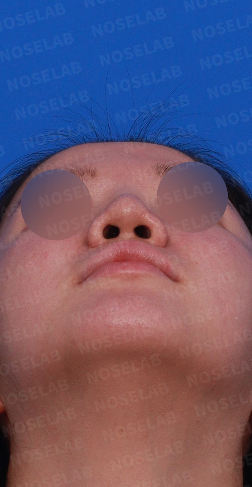 비중격 연골이 손상되면 코끝이 처지고 비주가 함몰되는 이유 — 디자인 상담 우측 측면, 비스듬한 측면 , 비공 사진