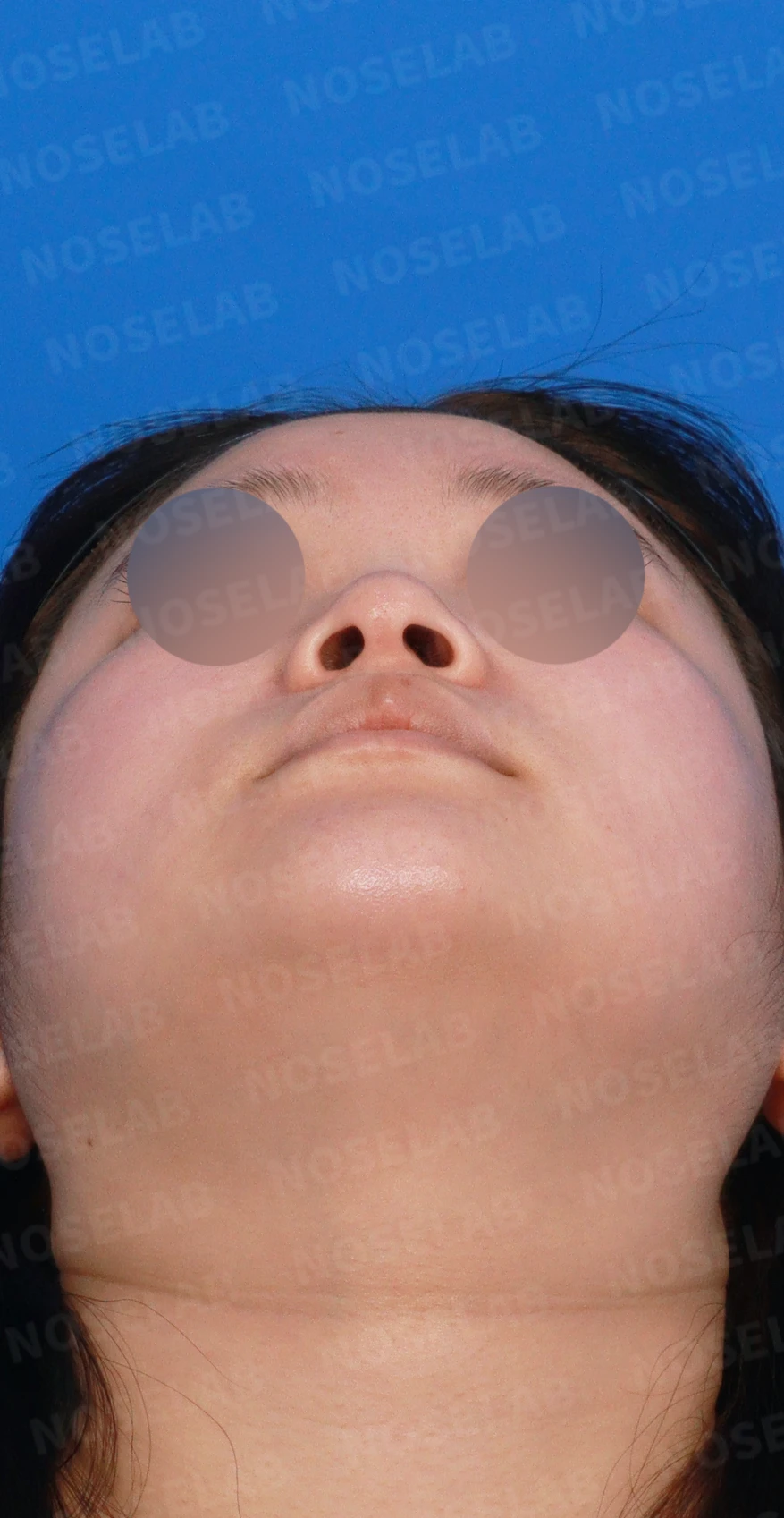 코가 퍼지고 코끝이 뭉툭해 보이는 이유, 비중격연골과 귀연골 교정은 어떻게 하나 — 디자인 상담 우측 측면, 비스듬한 측면, 비공 사진입니다.
