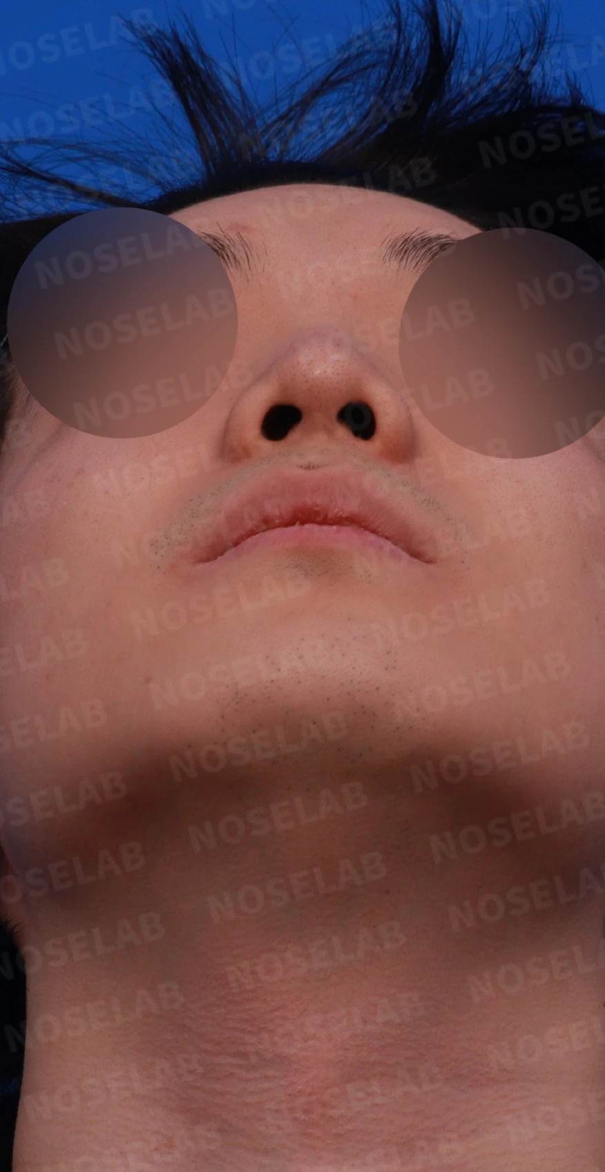 코 실 시술과 지방이식 후 라인이 잡히지 않는 이유, 제거와 늑연골 재건은 어떻게 하나 — 디자인 상담 우측 측면, 비스듬한 측면, 비공 사진입니다.