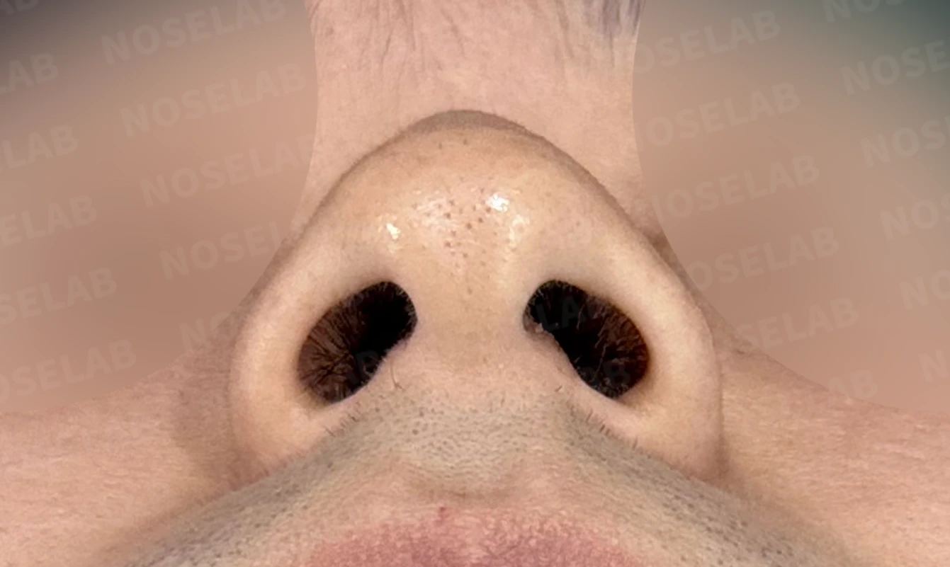 비중격이 휘면 코막힘과 휜 코가 함께 생기는 이유, 재건은 어떻게 하나 — 수술 전 / 수술 직후 0일 직후 사진은 부기가 있는 상태로 최종 결과와 다를 수 있습니다.