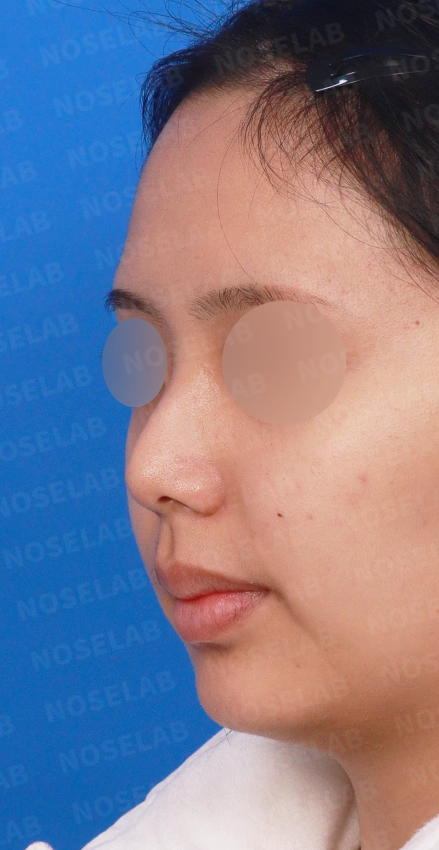 휘어진 매부리와 처진 코끝이 생기는 이유, 비중격 연장술은 어떻게 하나 — 디자인 상담 정면, 좌측 측면, 비스듬한 측면 사진입니다.