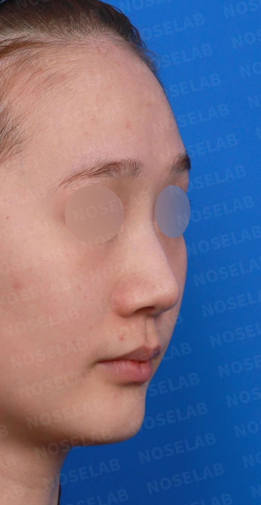 퍼진 코끝에 코막힘이 함께 오는 이유, 이물질 제거와 재건은 어떻게 하나 — 디자인 상담 우측 측면, 비스듬한 측면, 비공 사진입니다.