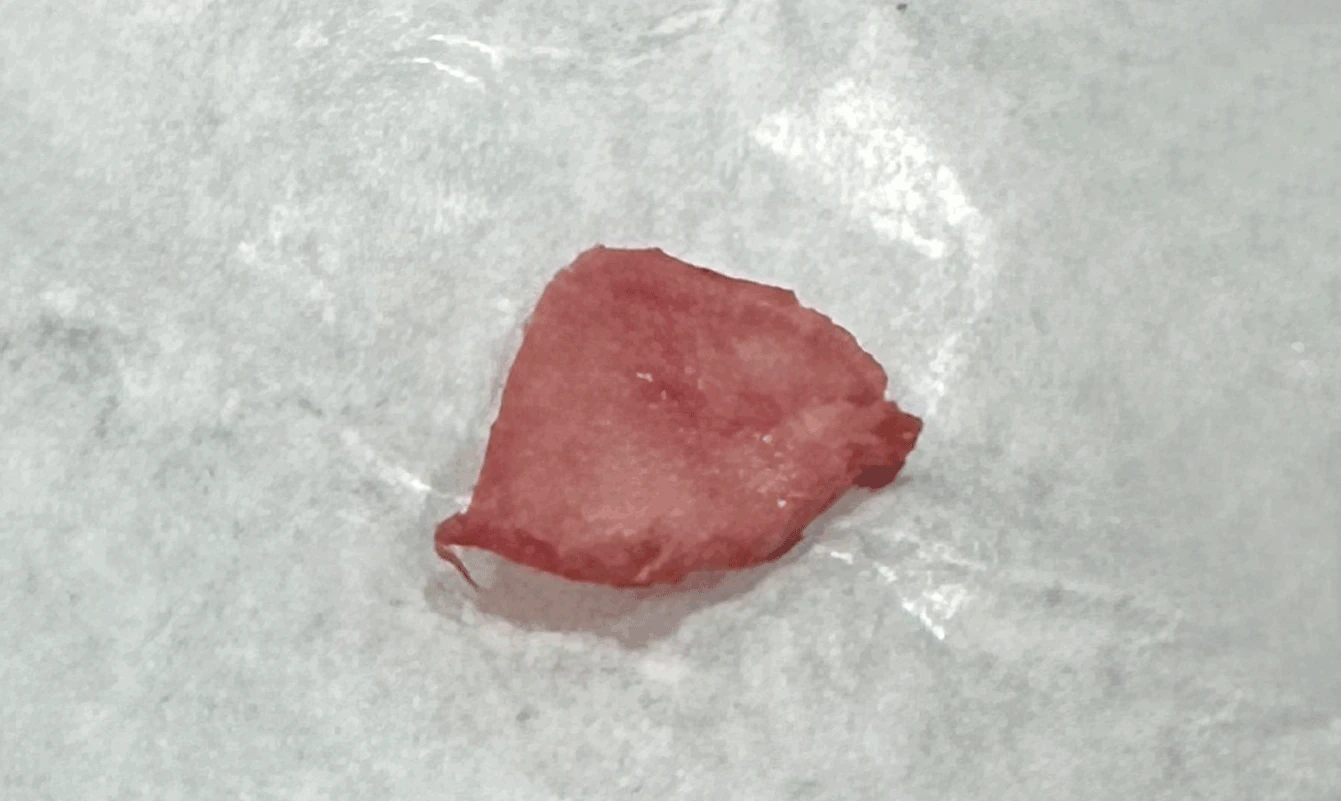 오래된 코성형 뒤 코끝이 들리고 콧구멍이 드러나는 이유, 제거와 자가진피 재건은 어떻게 하나 — 수술 중 메드포어 제거 사진.