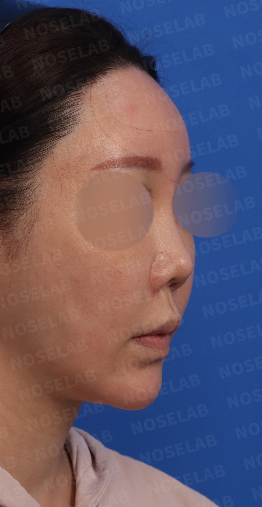 비주 함몰과 복코, 비공 비대칭의 교정 방법 — 정면, 측면, 비스듬한 측면
