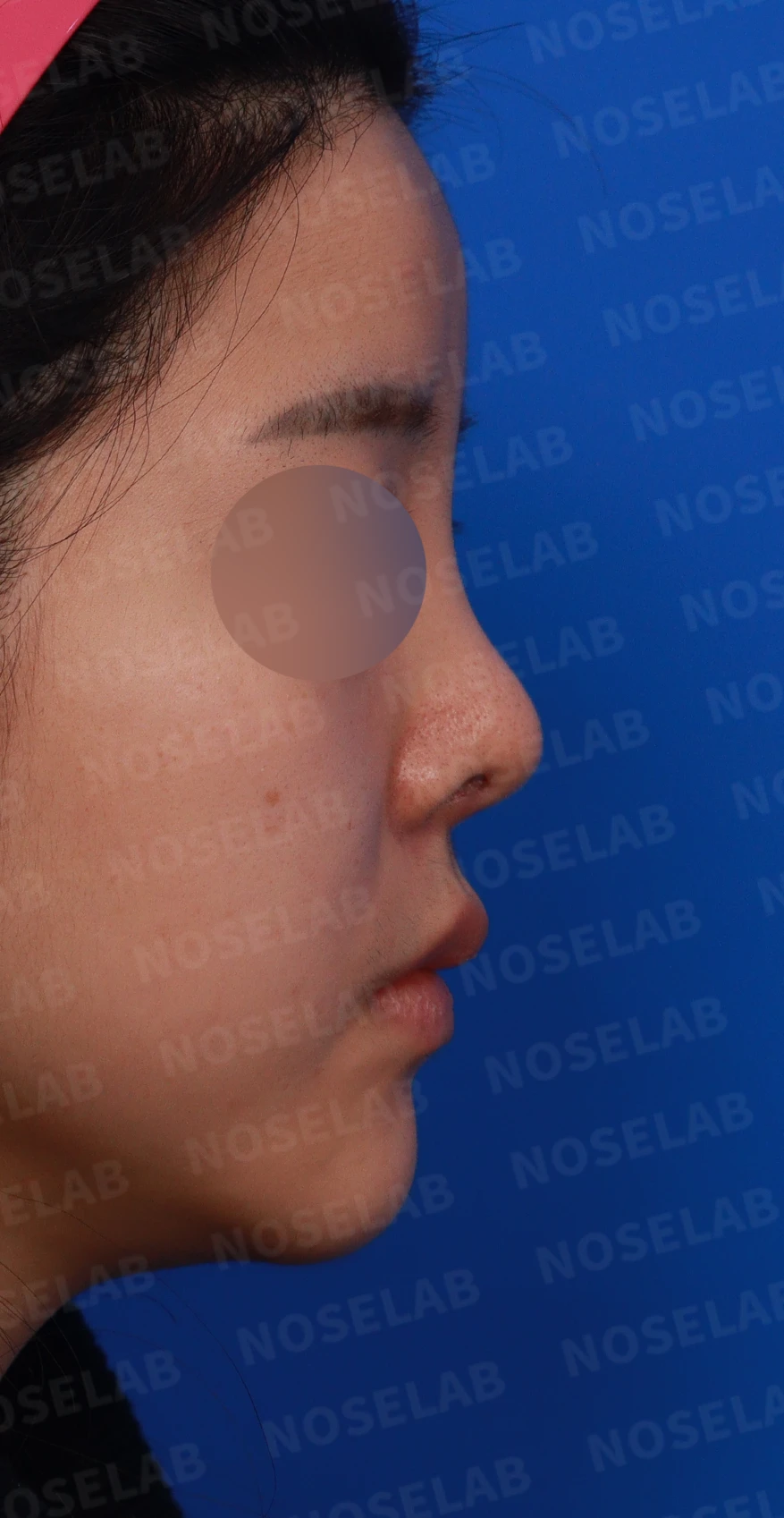 퍼진 콧대와 들린 코끝은 왜 생기나, 늑연골 재건은 어떻게 하나 — 디자인 상담 우측 비스듬한 측면, 측면, 비공 사진입니다.