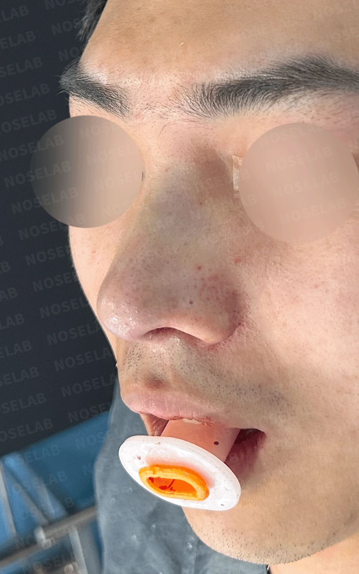 휜 코와 비공 노출 개선 - 자연스러운 코끝 상승 사례 — 직후 정면, 측면, 비스듬한 측면 사진