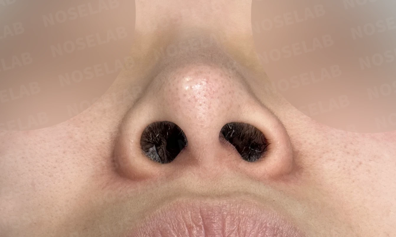 길고 처진 코, 휜코 교정과 코막힘까지 한 번에 해결한 재수술 사례 — 전(좌) 직후(후)