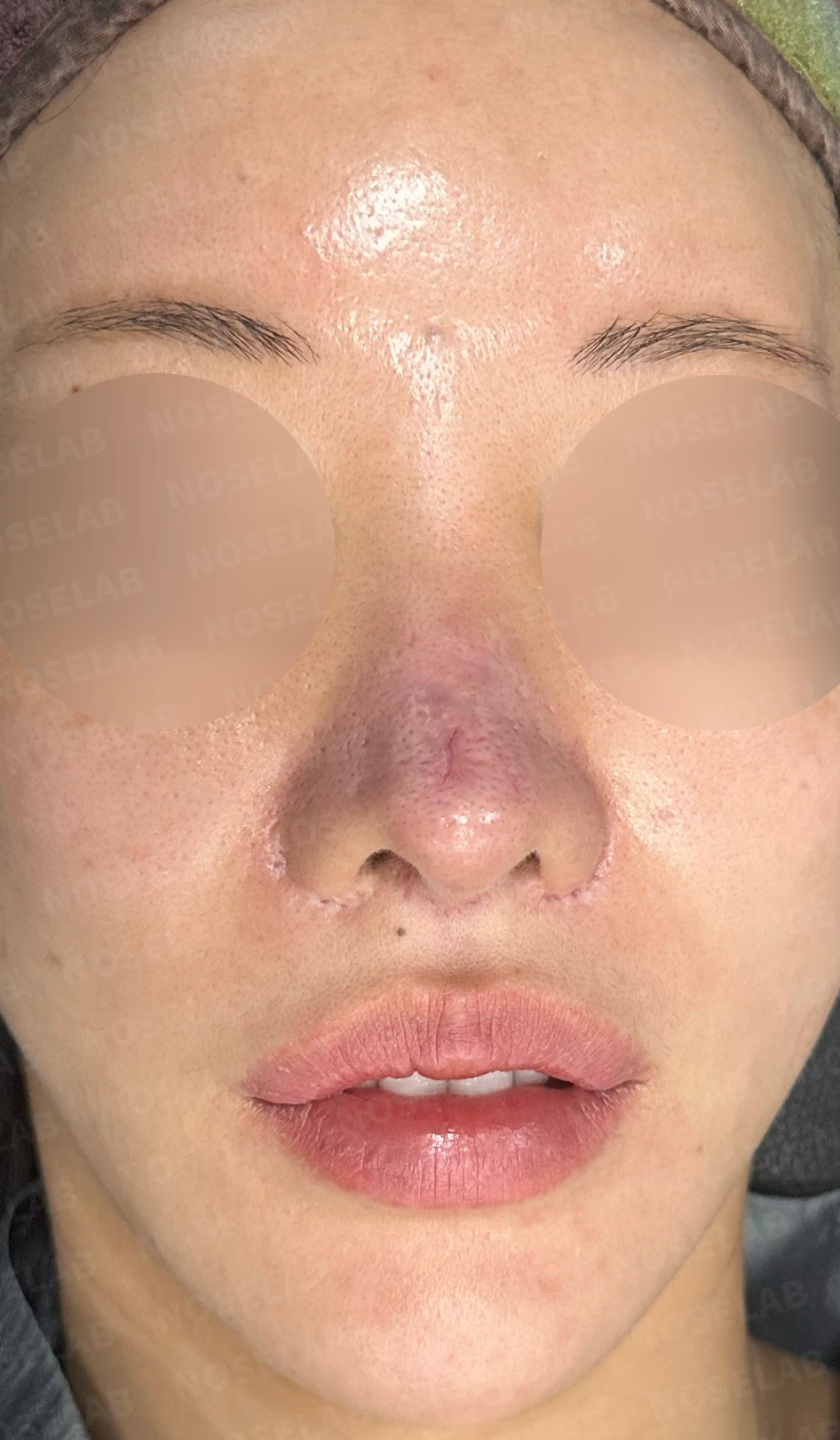 코 수술 뒤 콧등 피부가 괴사하면 어떤 변화가 남고, 재건은 어떻게 하나 — 수술 전 / 수술 직후 0일 직후 사진은 부기가 있는 상태로 최종 결과와 다를 수 있습니다.