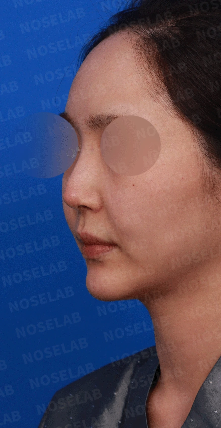 코끝 처짐과 코막힘을 함께 살펴보는 재수술 방법 — 디자인 상담 정면, 좌측 측면, 비스듬한 측면 사진입니다.