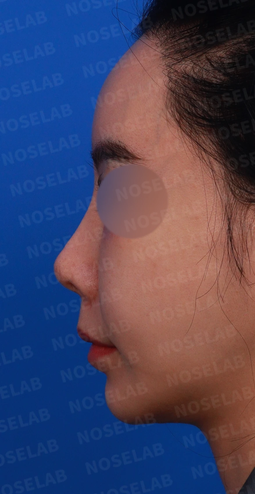 이식한 진피가 반복해서 흡수되는 이유, 재건은 어떻게 하나 — 디자인 상담 정면, 좌측 측면, 비스듬한 측면 사진입니다.