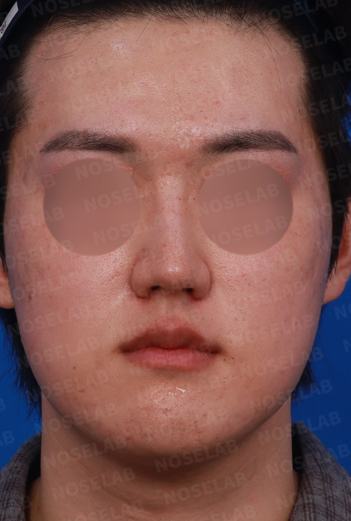 보형물 없이 코끝과 경계 부분만 교정하는 방법 — 디자인 상담 정면, 좌측 측면, 비스듬한 측면 사진