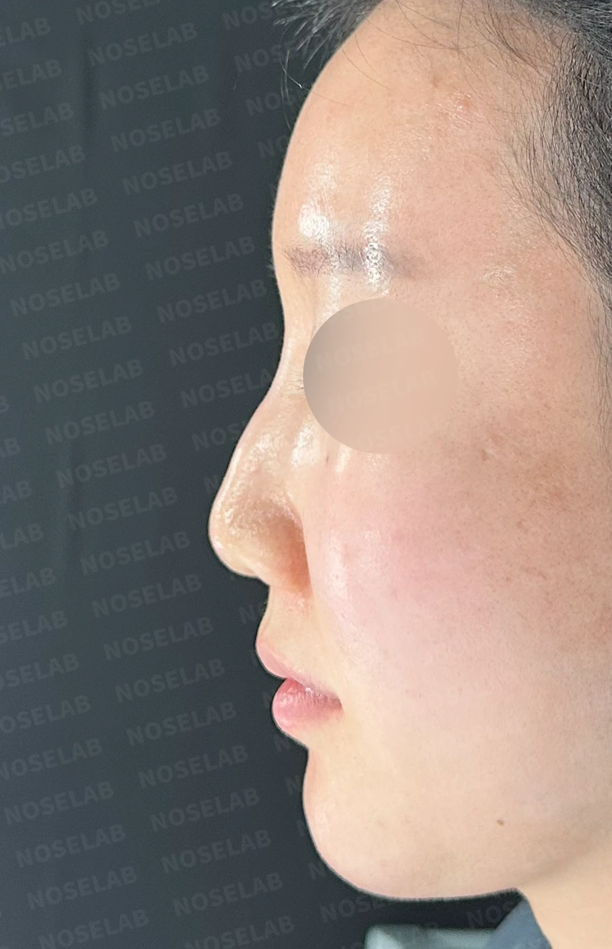 비공 비대칭과 코끝 처짐은 왜 생기나, 연골을 병용한 재건 방법 — 수술 전 / 수술 직후 0일 직후 사진은 부기가 있는 상태로 최종 결과와 다를 수 있습니다.