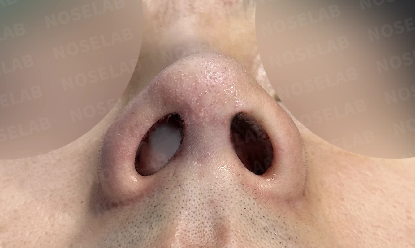 비중격이 휘면 코막힘과 휜 코가 함께 생기는 이유, 재건은 어떻게 하나 — 수술 전 / 수술 직후 0일 직후 사진은 부기가 있는 상태로 최종 결과와 다를 수 있습니다.