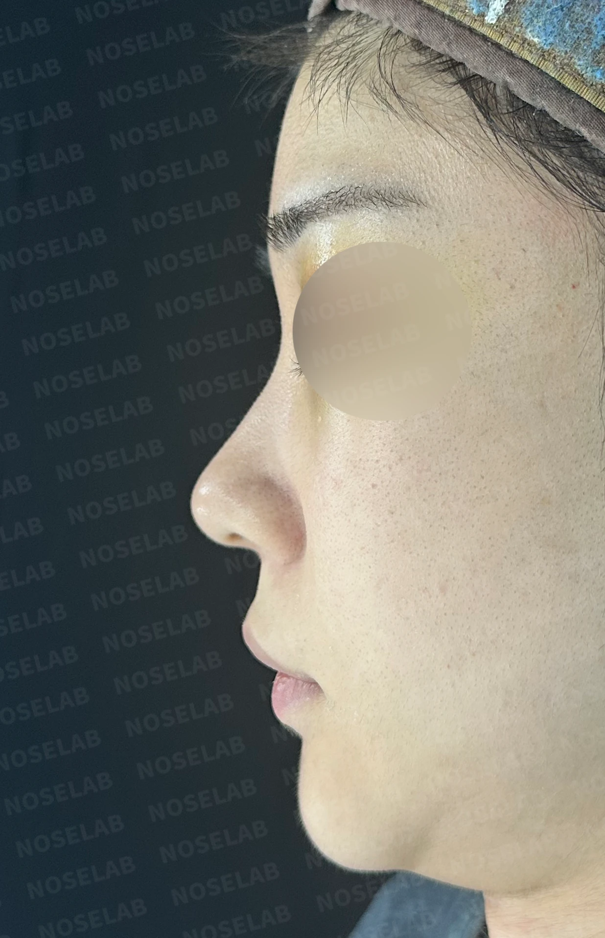 코가 뭉툭하고 퍼져 보이는 이유, 비순각과 비주는 어떻게 교정하나 — 수술 전 / 수술 직후 0일 직후 사진은 부기가 있는 상태로 최종 결과와 다를 수 있습니다.