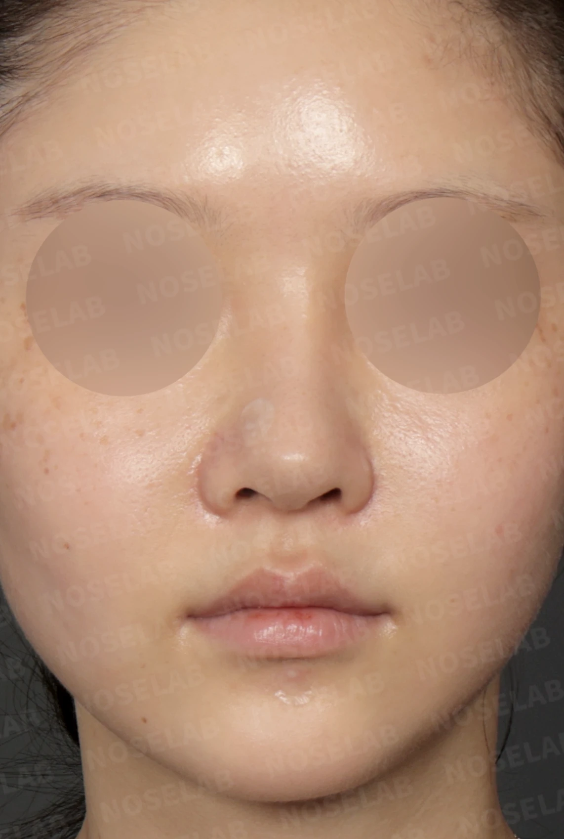 휘어진 코와 복코, 자가늑연골 비중격 재건으로 안전하게 교정한 코재수술 — 디자인 상담 정면, 비스듬한 측면 , 측면 사진입니다.