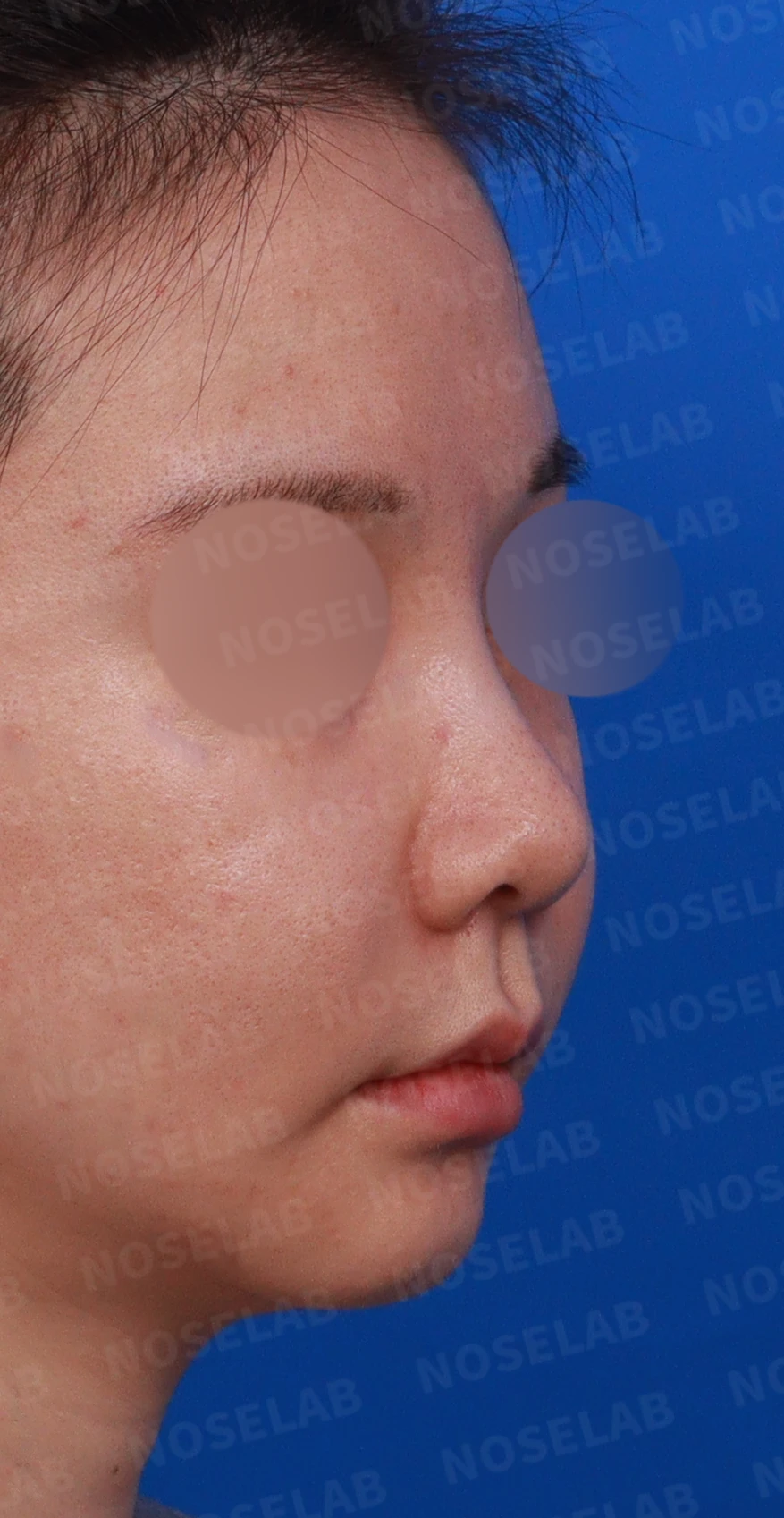 필러와 실 시술 뒤 코가 뭉툭해지는 이유, 이물질 제거와 코끝 교정 방법 — 디자인 상담 우측 비스듬한 측면, 측면, 비공 사진