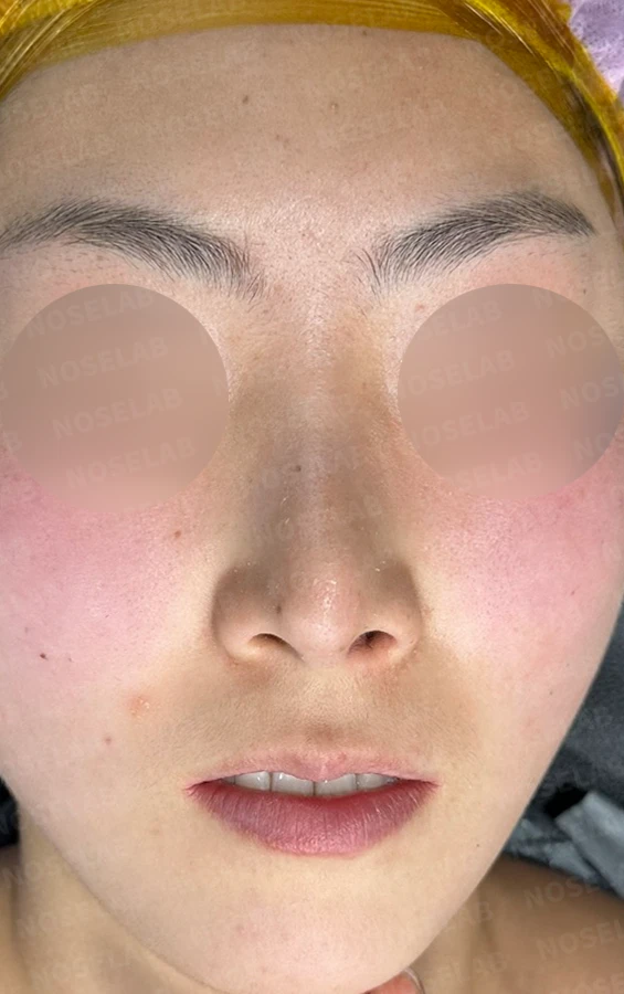 기능성 코성형·휘어진 비주 바로잡기 방법 — 수술 전 / 수술 직후 0일 직후 사진은 부기가 있는 상태로 최종 결과와 다를 수 있습니다.