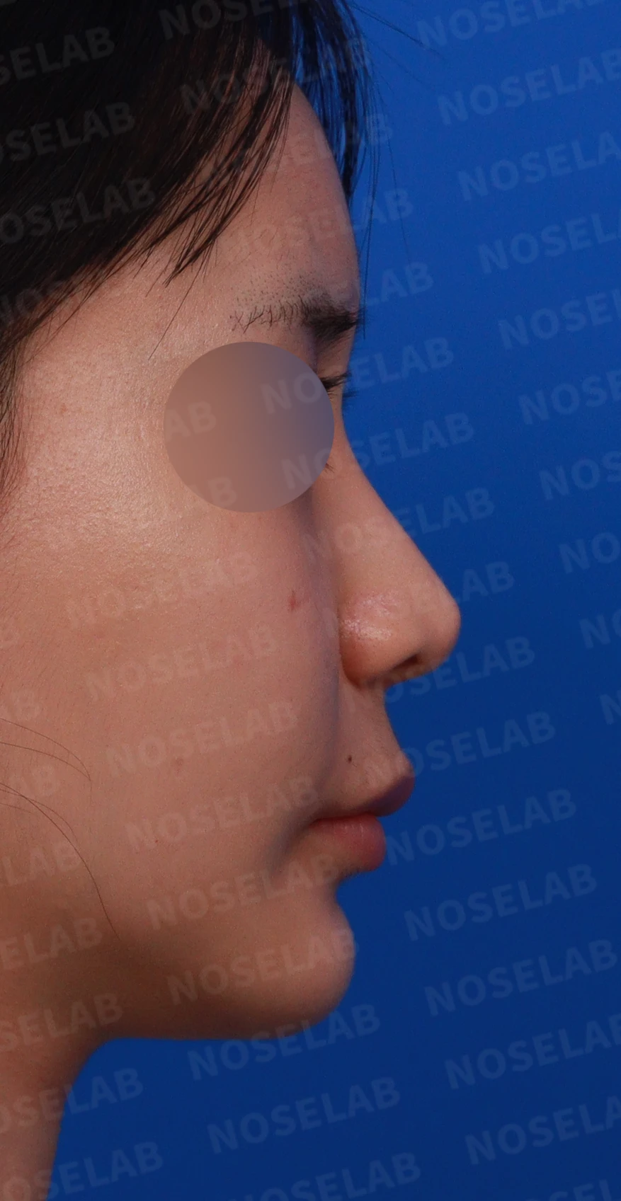양악수술 뒤 비중격이 손상되고 비염이 재발하는 이유 — 디자인 상담 정면, 우측 측면, 비스듬한 측면 사진