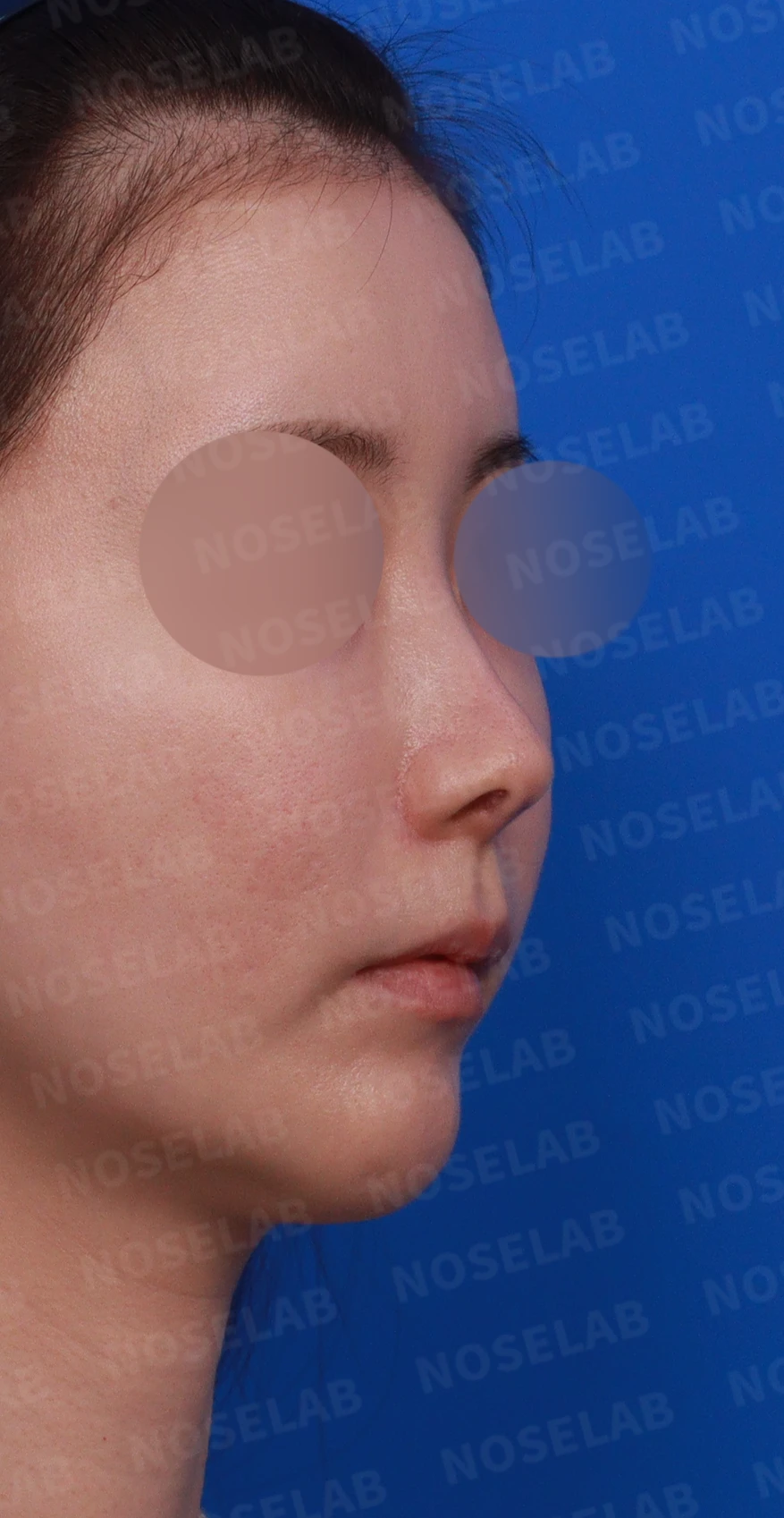 코성형 후 남는 미세한 높이 부족과 좌우 비대칭, 왜 생기고 어떻게 보강하나 — 디자인 상담 우측 비스듬한 측면 , 측면 , 비공 사진입니다.