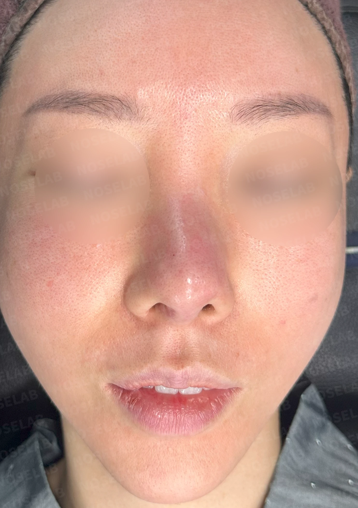 반복된 코성형 뒤 구축과 코막힘이 함께 생기는 이유, 재건은 어떻게 하나 — 수술 전 / 수술 직후 0일 직후 사진은 부기가 있는 상태로 최종 결과와 다를 수 있습니다.