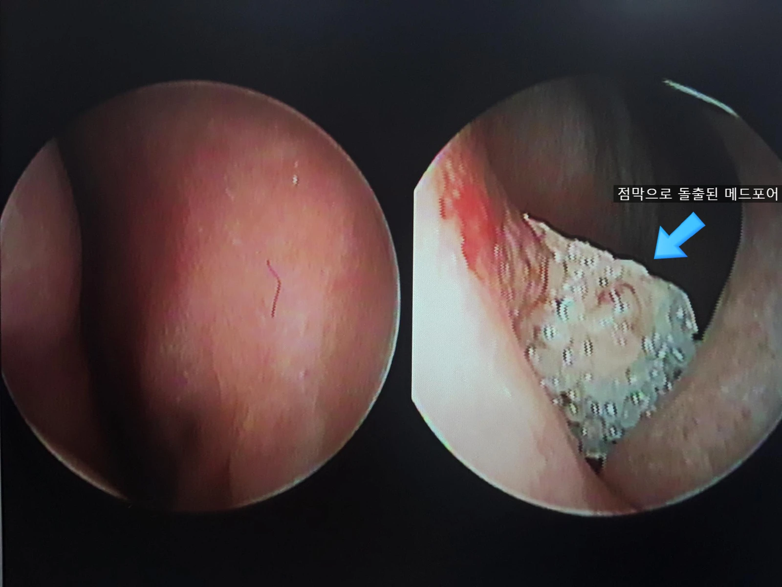 메드포어 점막 돌출로 인한 염증 코 - 자가늑연골 재건 수술 후기 — 비내시경 사진입니다.
