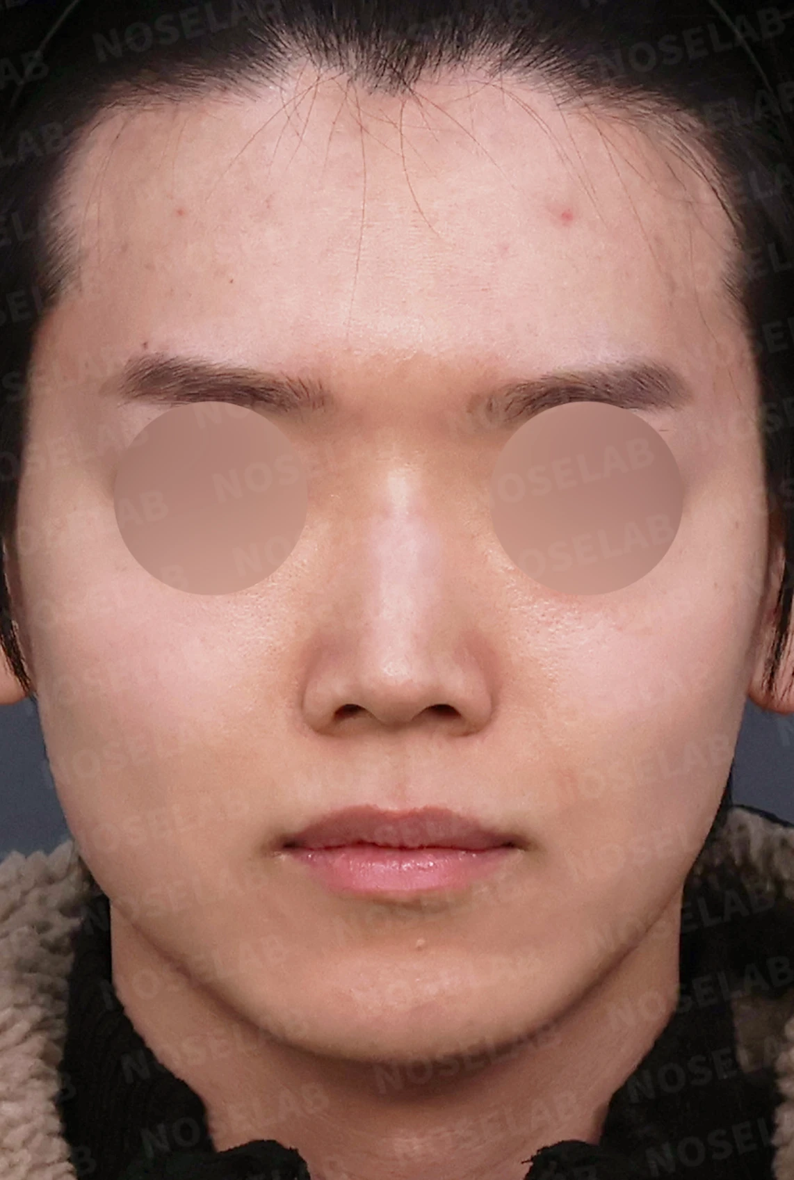 코가 낮아 보이는 이유와 자가 늑연골로 높이를 만드는 방법 — 디자인 상담 정면, 좌측 측면, 비스듬한 측면 사진입니다.