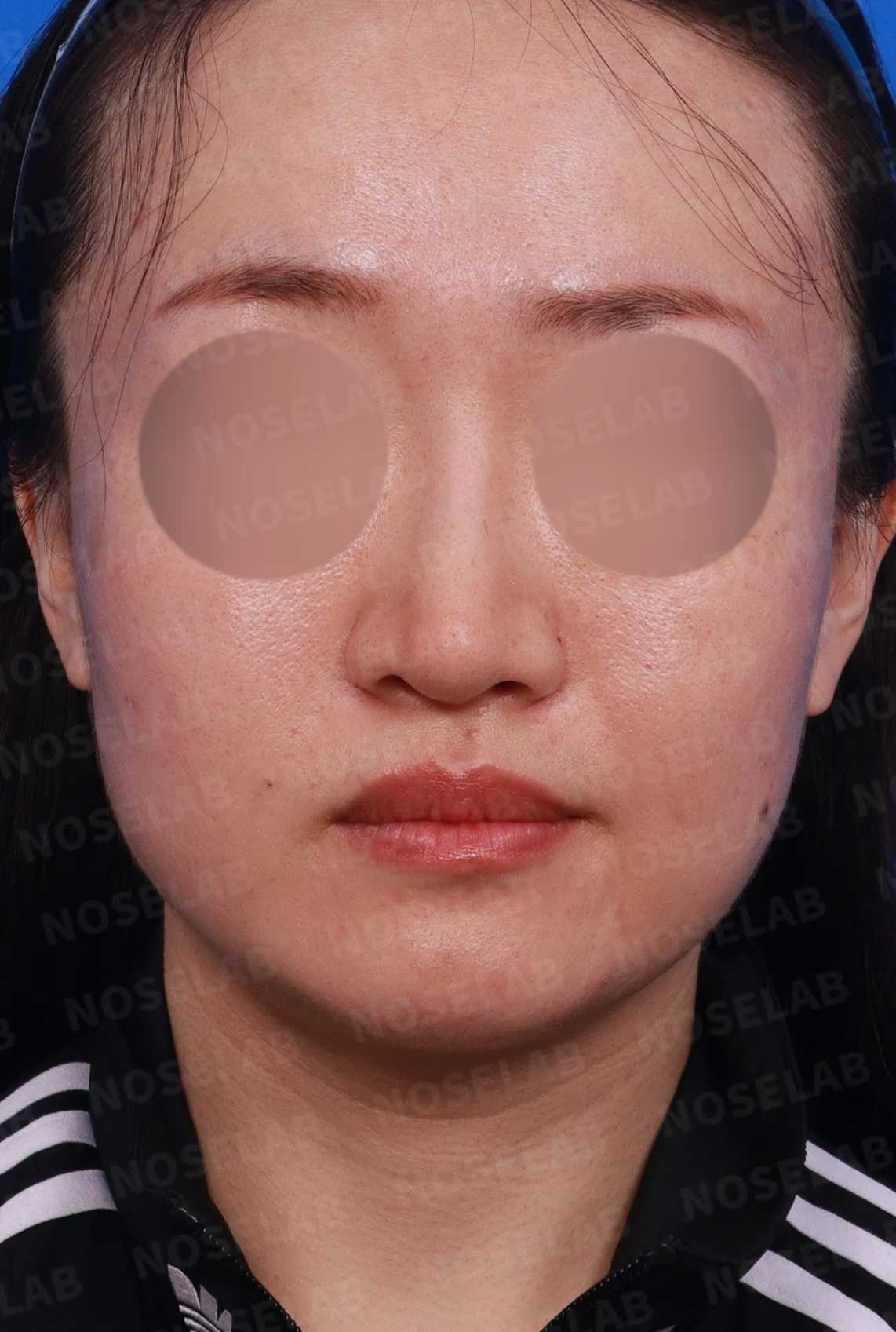 콧볼 축소 뒤 코가 뭉툭하고 길어 보이는 이유, 어떻게 교정하나 — 디자인 상담 정면, 좌측 측면, 비스듬한 측면 사진