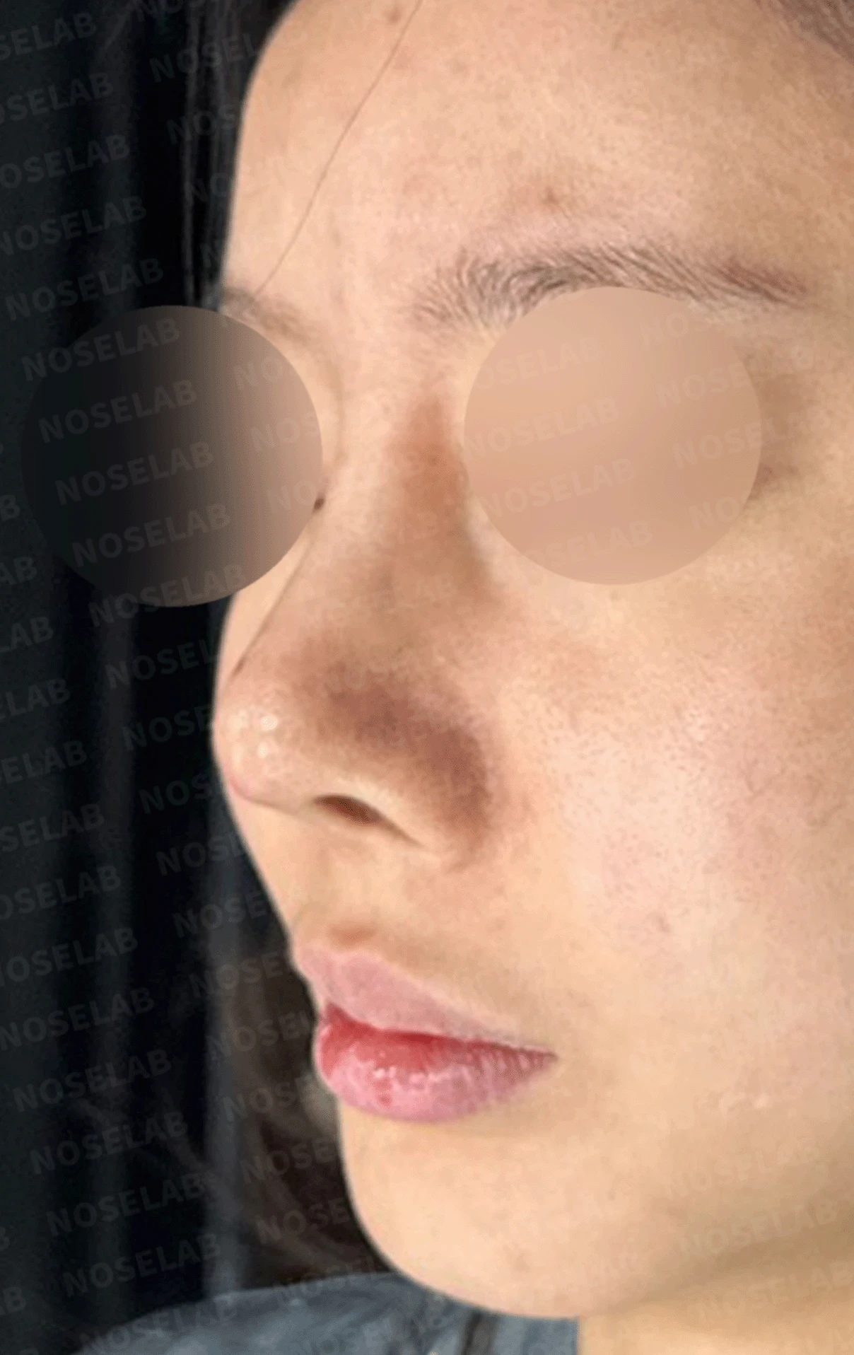 실리콘 보형물이 코끝 피부를 뚫고 나오려 할 때, 왜 생기고 어떻게 재건하나 — 본문 사진 17