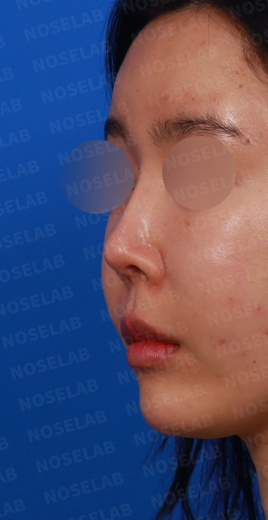 코가 들리고 콧기둥이 꺼지며 코끝이 찝혀 보이는 이유, 복합 교정은 어떻게 하나 — 디자인 상담 정면, 좌측 측면, 비스듬한 측면 사진