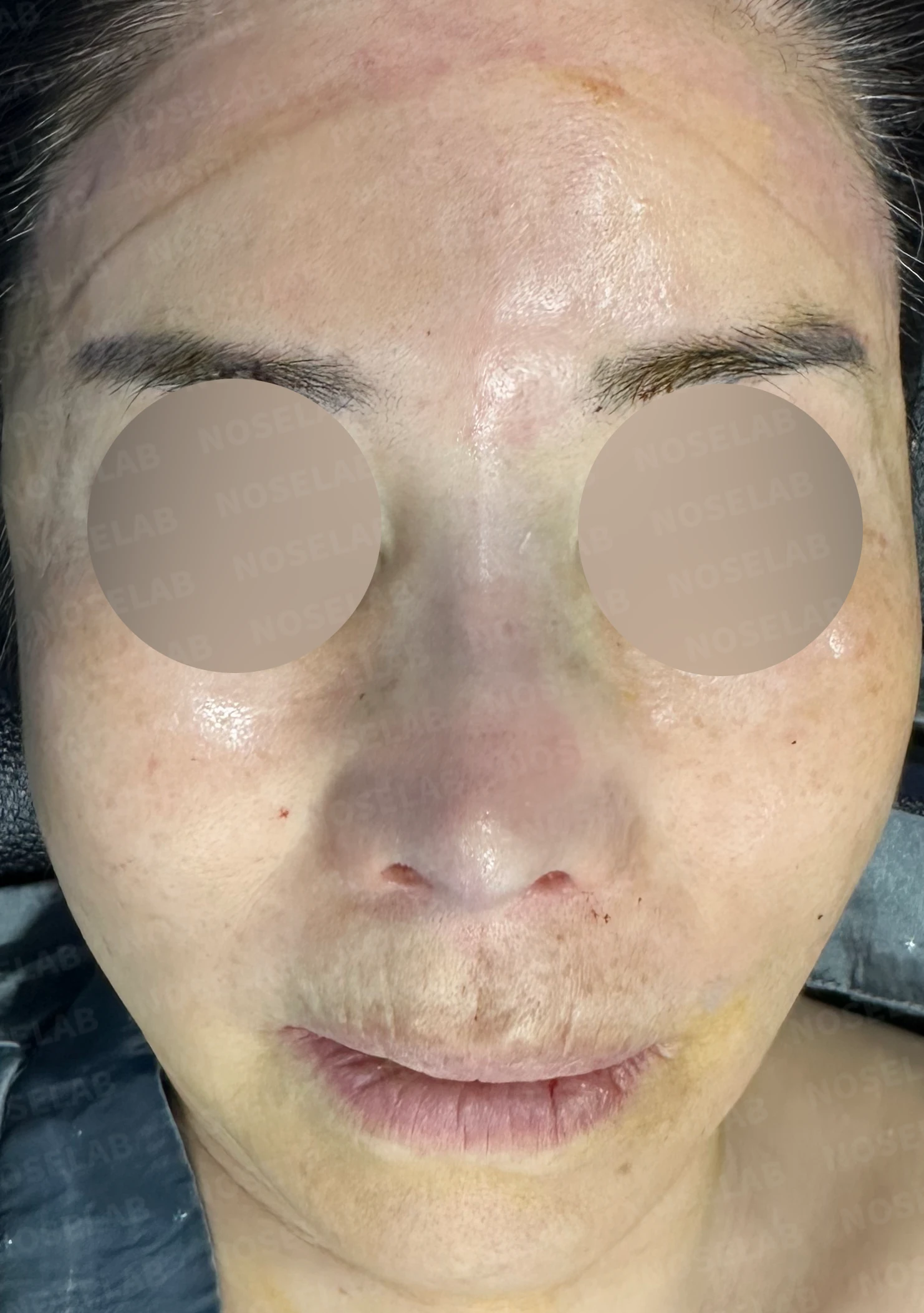 오래된 실리콘 보형물이 변형과 통증을 일으키는 이유, 늑연골 재건은 어떻게 하나 — 수술 전 / 수술 직후 0일 직후 사진은 부기가 있는 상태로 최종 결과와 다를 수 있습니다.