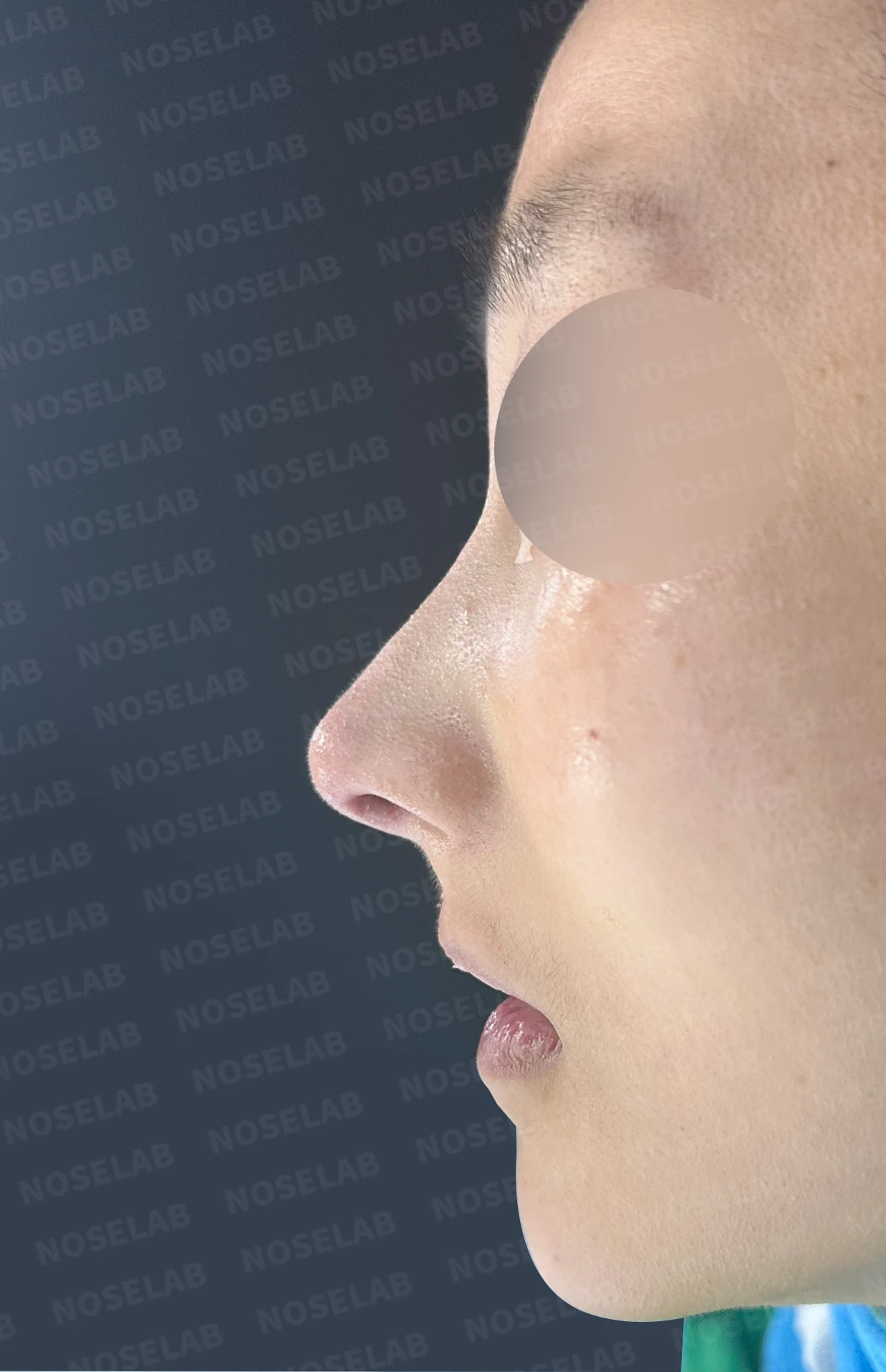 코가 한쪽으로 휘어 보이고 밤에 막히는 이유, 비중격 재건과 코막힘 개선 — 수술 직후 0일 정면 , 비스듬한 측면 , 측면 사진입니다. 직후 사진은 부기가 있는 상태로 최종 결과와 다를 수 있습니다.