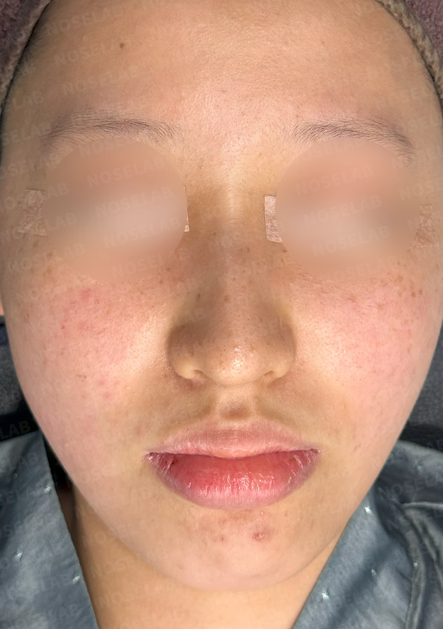 매부리코와 처진 코끝이 함께 있을 때, 콧대와 코끝의 균형 잡는 법 — 수술 전 / 수술 직후 0일 직후 사진은 부기가 있는 상태로 최종 결과와 다를 수 있습니다.