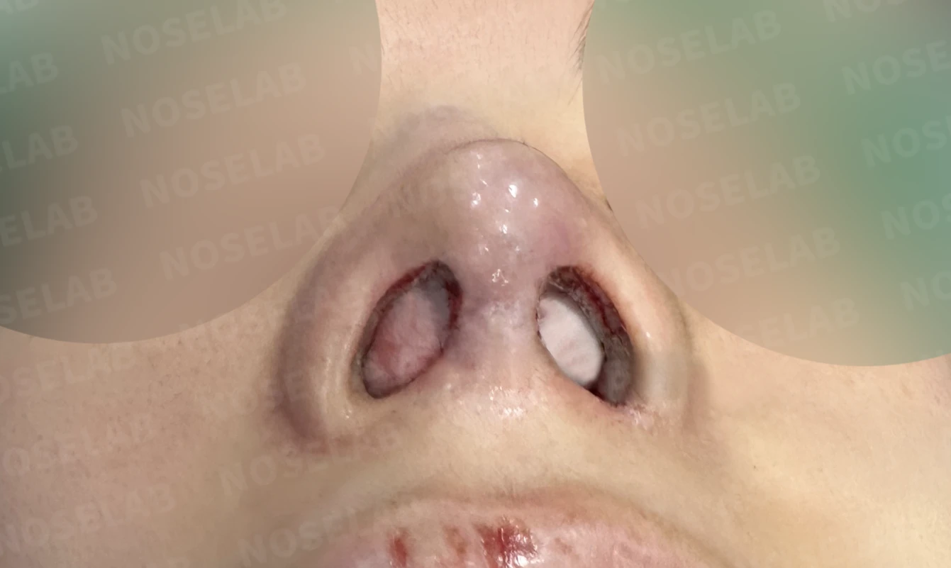 여러 차례 수술 뒤 코막힘이 남는 이유, 비중격과 비밸브 재건은 어떻게 하나 — 수술 전 / 수술 직후 0일 직후 사진은 부기가 있는 상태로 최종 결과와 다를 수 있습니다.