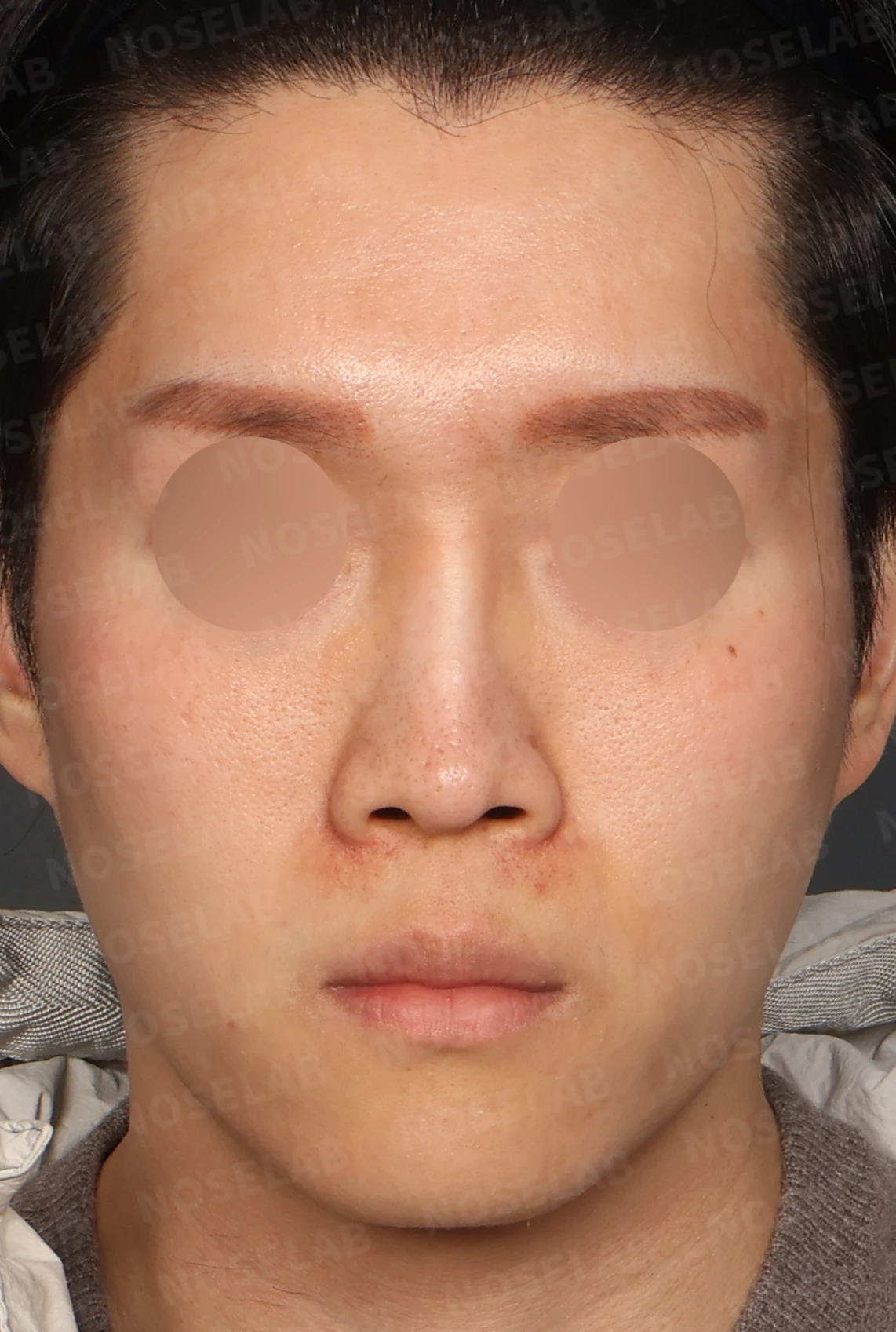 2차 코재수술, 자가늑연골로 비중격 재건과 직선 코 라인 완성 — 디자인 상담 정면, 좌측 측면, 비스듬한 측면 사진