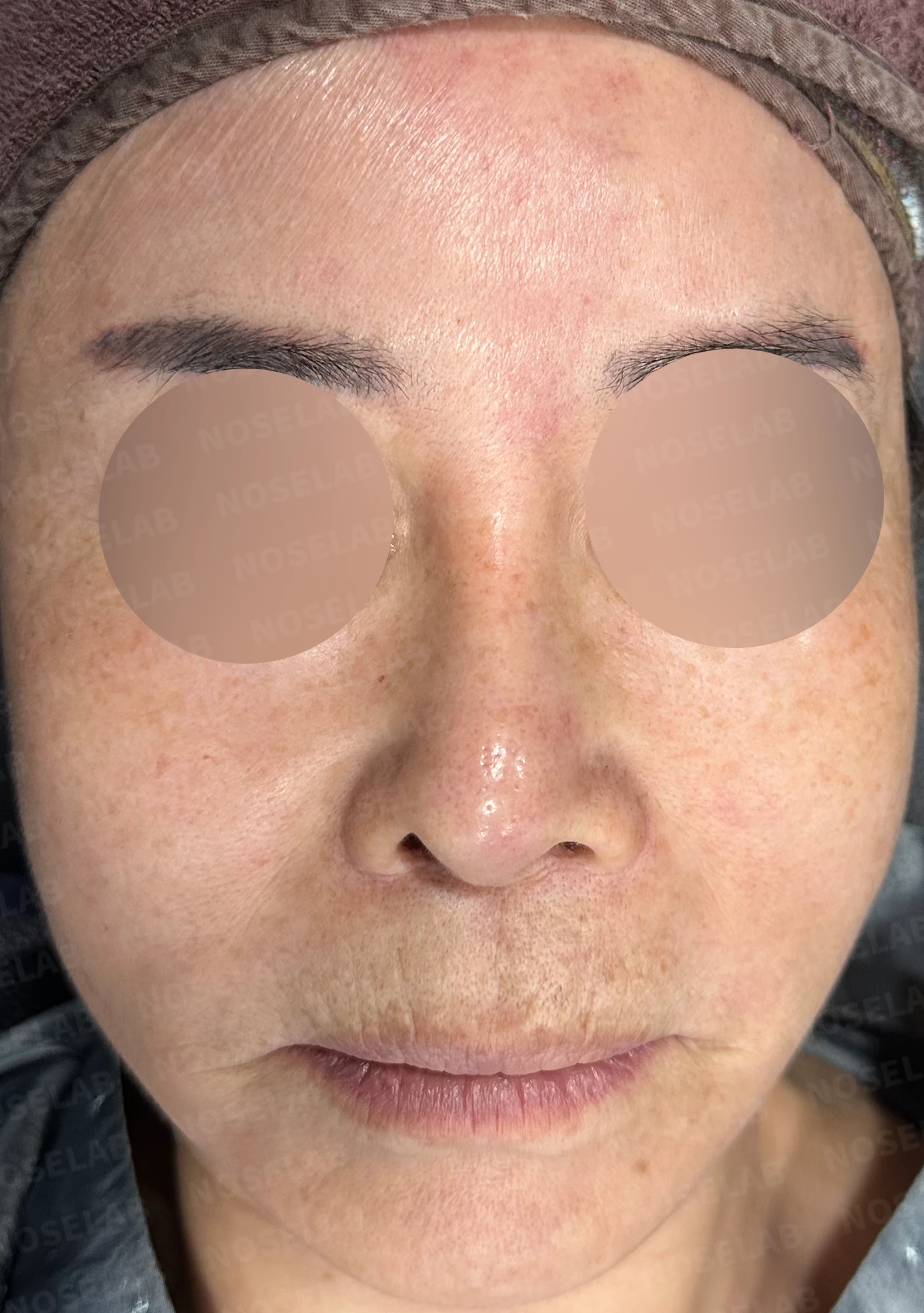 오래된 실리콘 보형물이 변형과 통증을 일으키는 이유, 늑연골 재건은 어떻게 하나 — 수술 전 / 수술 직후 0일 직후 사진은 부기가 있는 상태로 최종 결과와 다를 수 있습니다.
