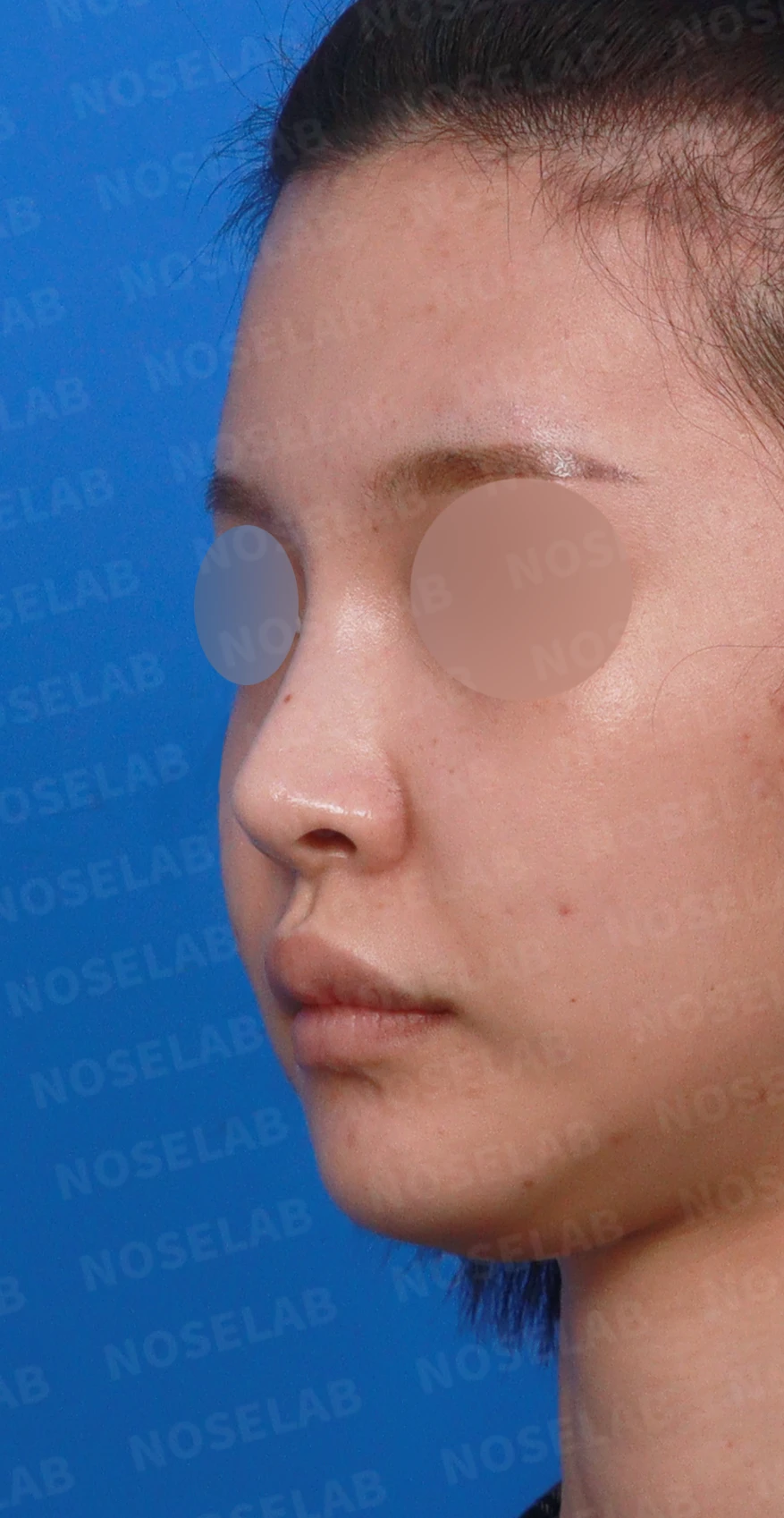 코 시작점이 높고 코끝이 들려 보이는 이유와 교정 방법 — 디자인 상담 정면, 좌측 측면, 비스듬한 측면 사진입니다.