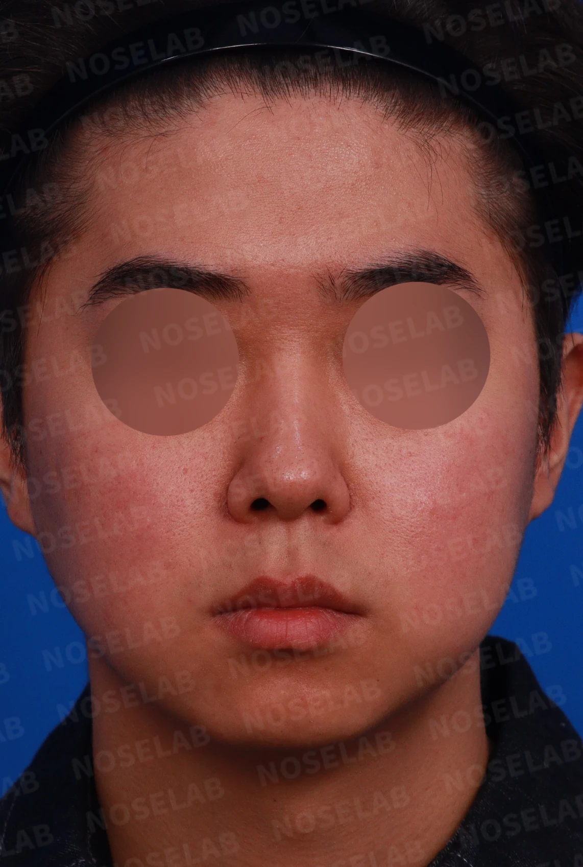 짧고 낮은 코의 지지 구조와 교정 방법 — 디자인 상담 정면, 좌측 비스듬한 측면, 측면
