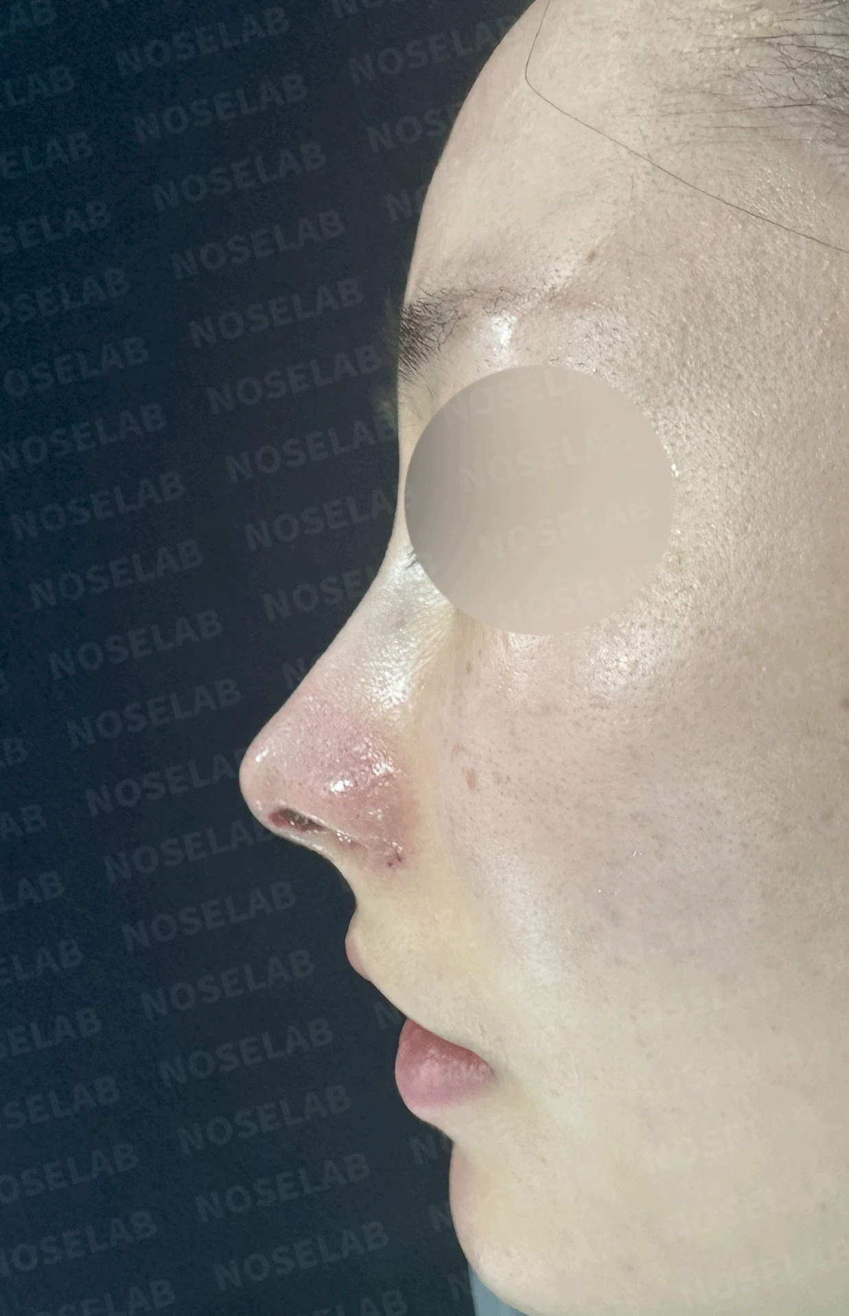 매부리코와 휜 코에 코막힘이 함께 오는 이유, 복합 교정은 어떻게 하나 — 수술 직후 0일 정면, 측면, 비스듬한 측면 사진입니다. 직후 사진은 부기가 있는 상태로 최종 결과와 다를 수 있습니다.