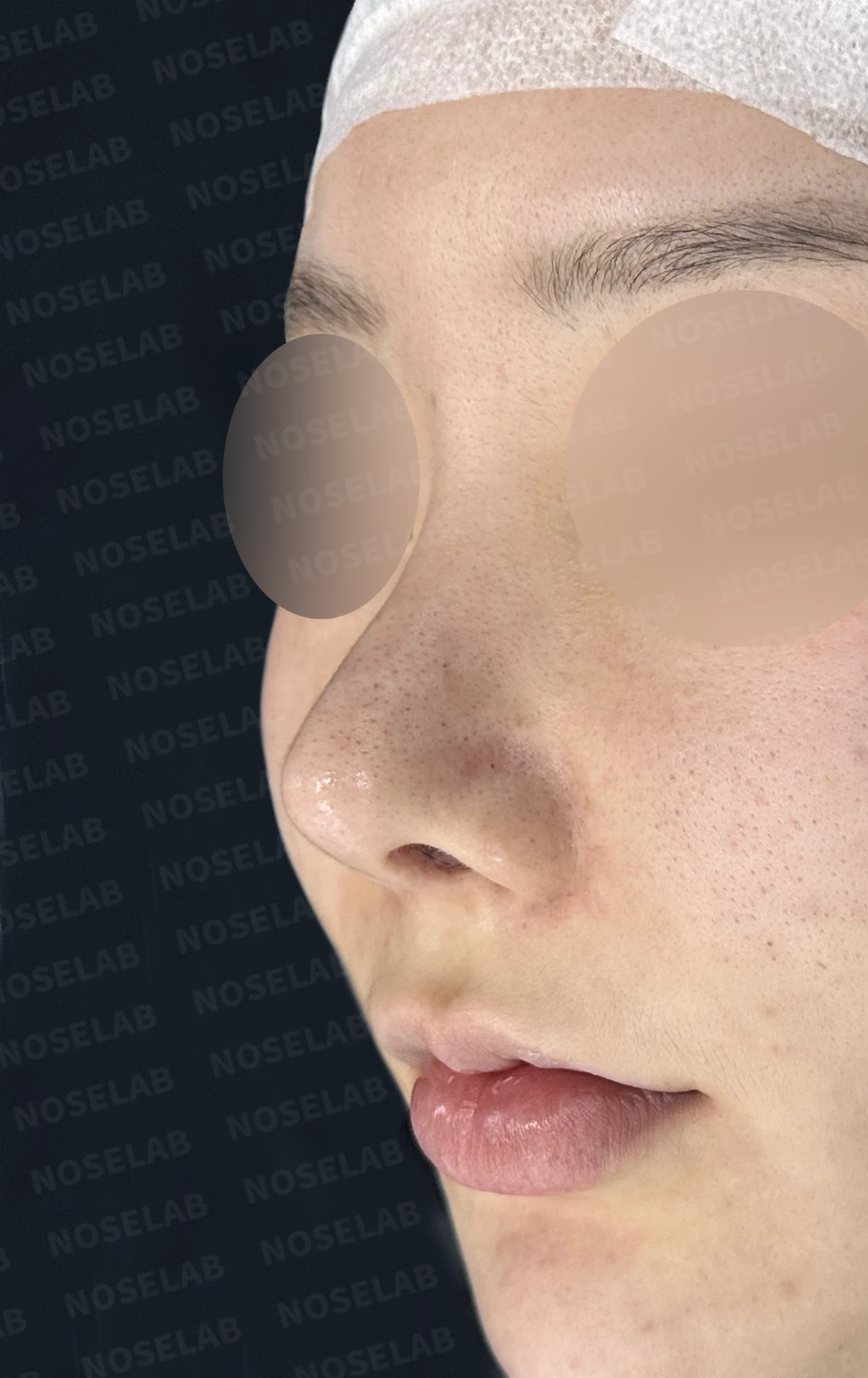 휘어진 코와 비공 비대칭, 자가늑연골 비중격 재건으로 완성한 코재수술 — 전(좌) 직후(후)