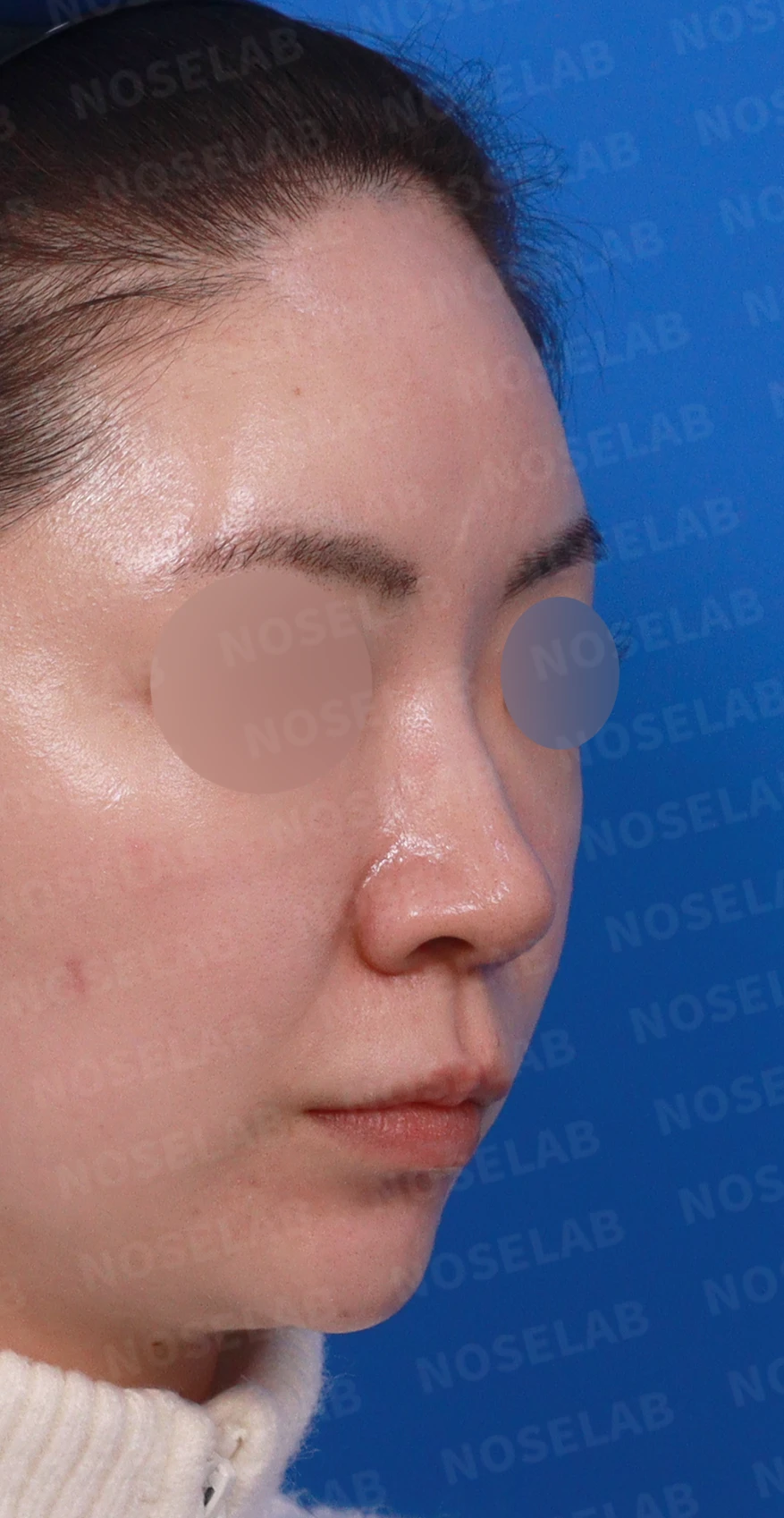 코끝이 퍼져 보이는 이유와 코바닥·비순각을 함께 다루는 방법 — 디자인 상담 우측 측면, 비스듬한 측면, 비공 사진입니다.
