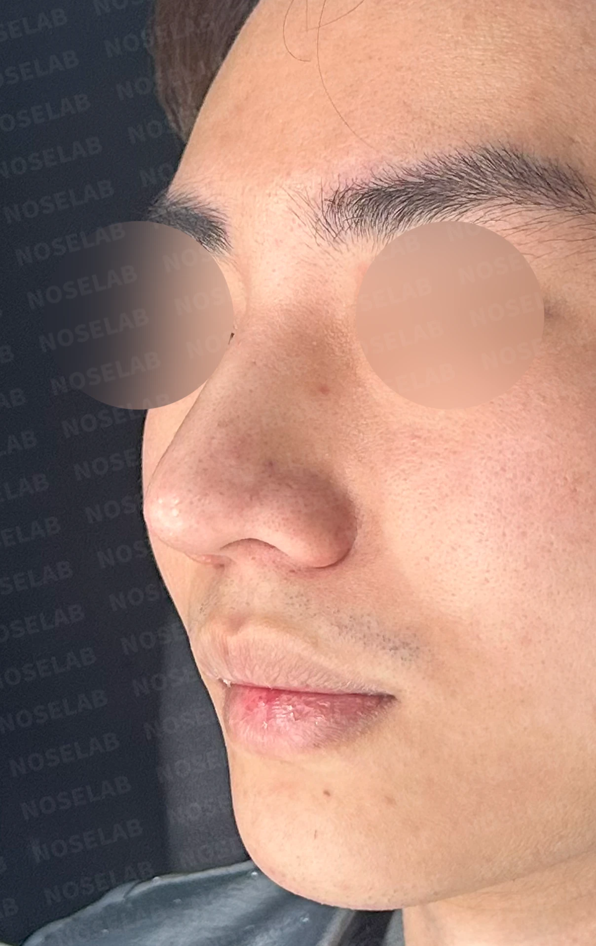 코뼈 골절에 미용 수술을 함께 할 수 있는 경우와 단계로 나누는 방법 — 수술 전 / 수술 직후 0일 직후 사진은 부기가 있는 상태로 최종 결과와 다를 수 있습니다.