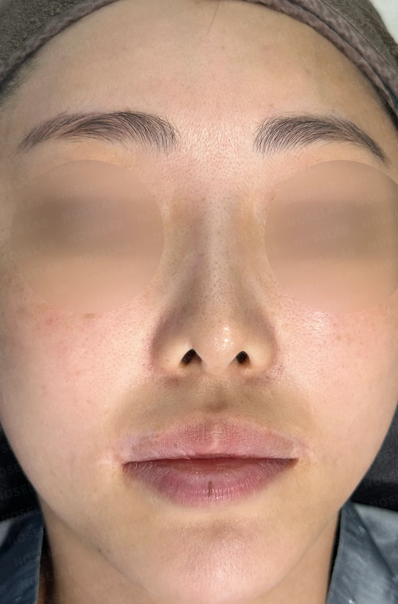 들린 코에서 비공 내리기를 계획하는 방법 — 수술 전 / 수술 직후 0일 직후 사진은 부기가 있는 상태로 최종 결과와 다를 수 있습니다.